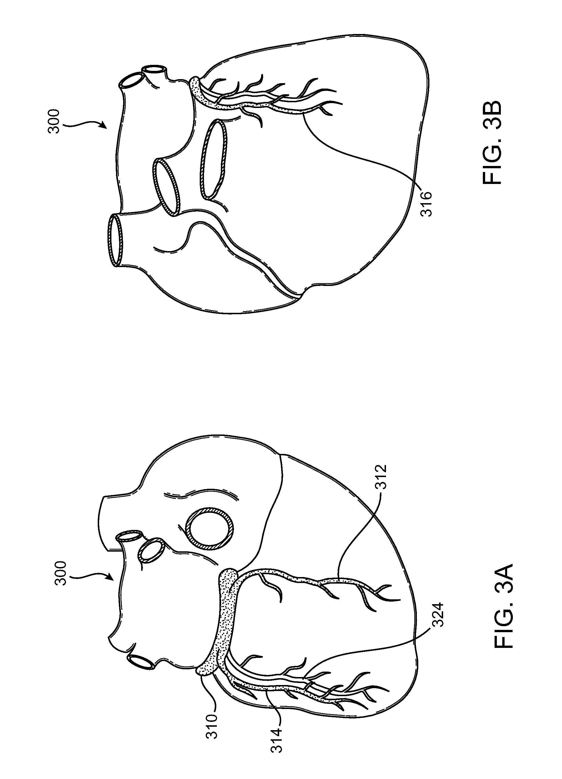 Reference Devices for Placement in Heart Structures for Visualization During Heart Valve Procedures