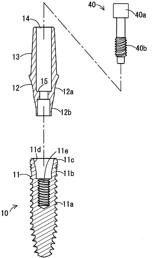 Dental implant