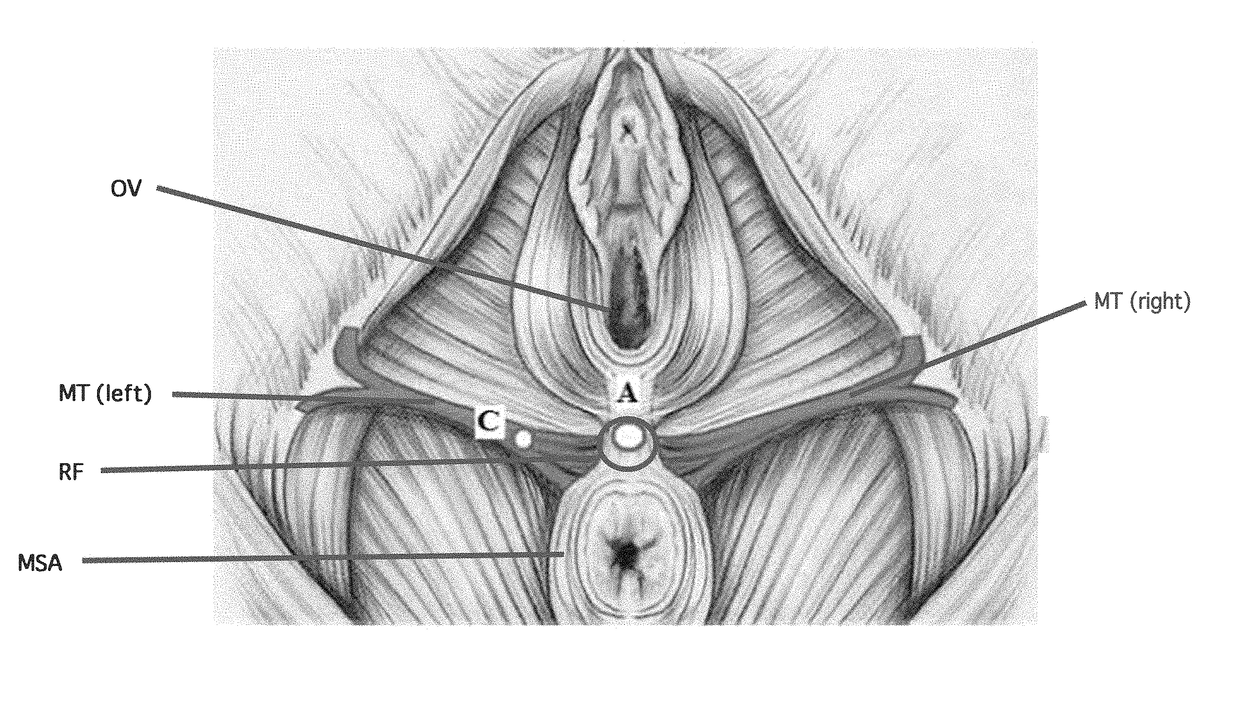 Minimally invasive surgical technique to perform vaginal ostioplastic and anus tightening