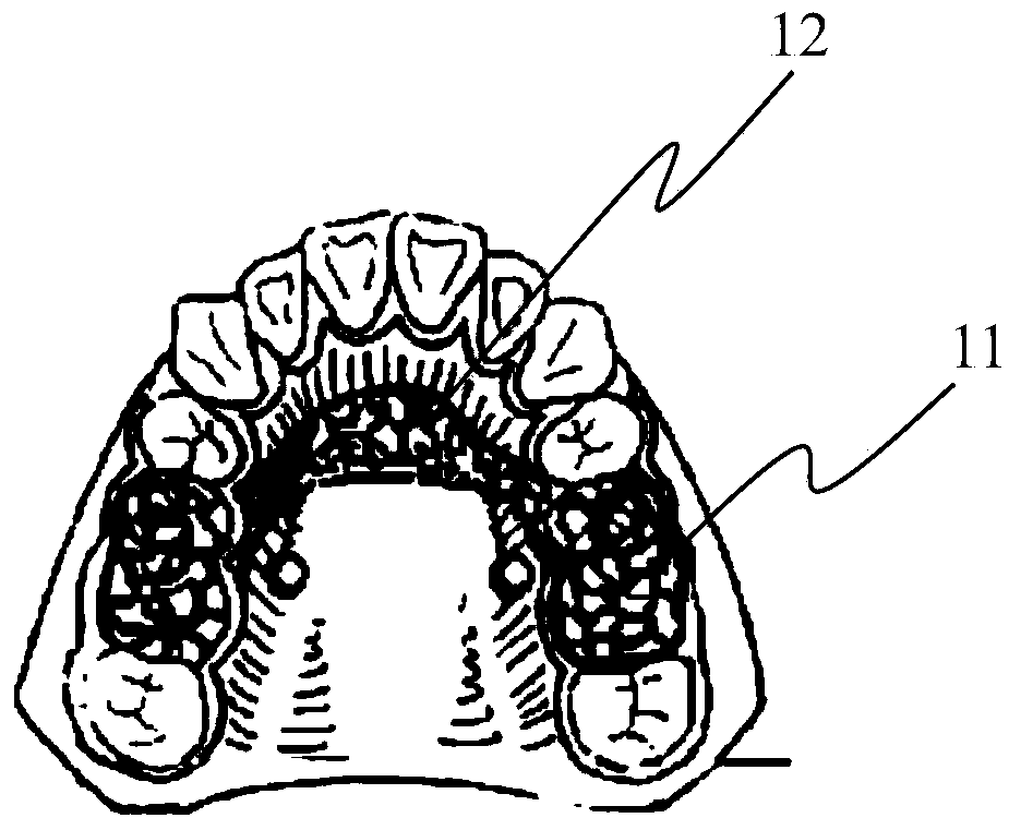 Device of using implant anchorage to distalize maxillary molar