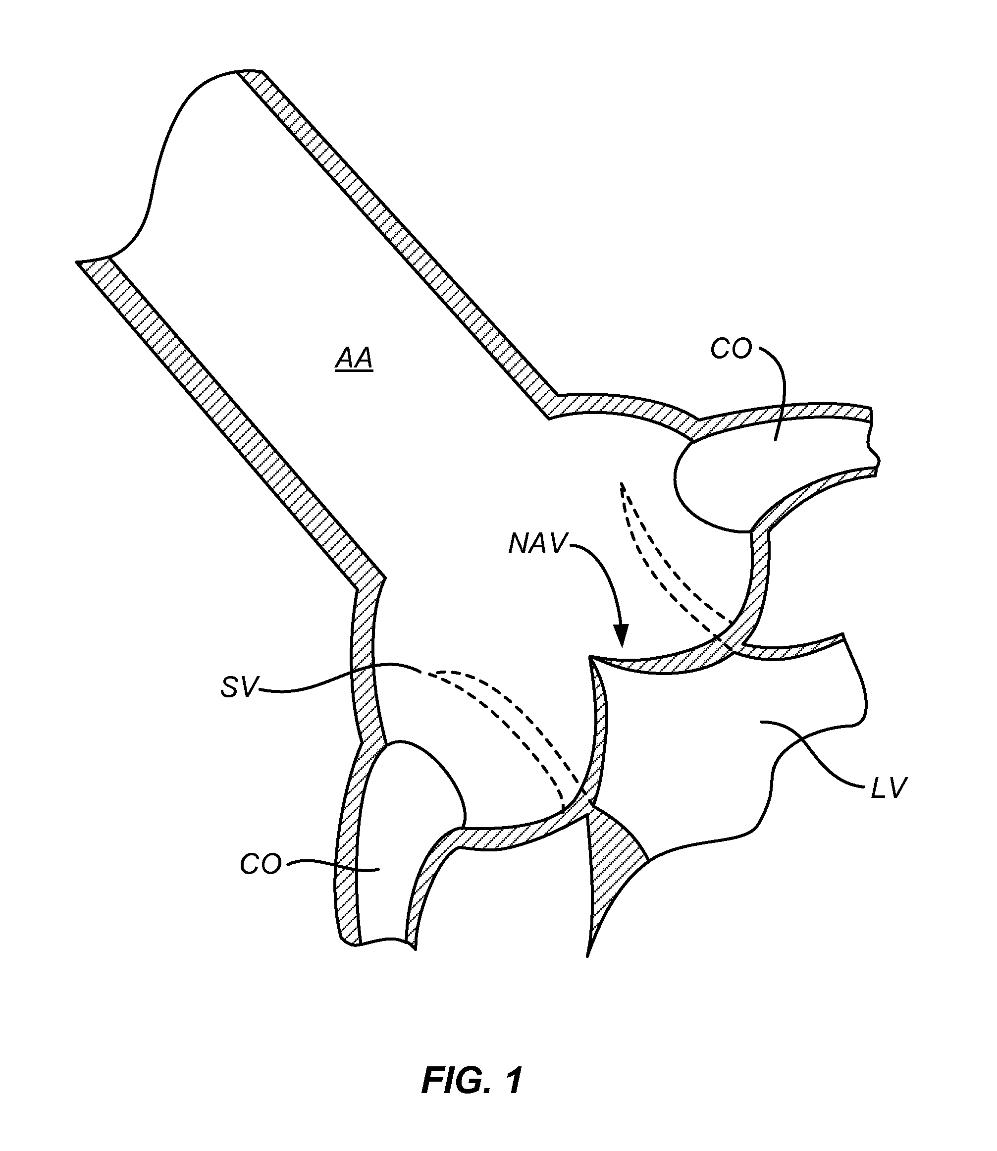 Method and system for balloon counterpulsation during aortic valve replacement