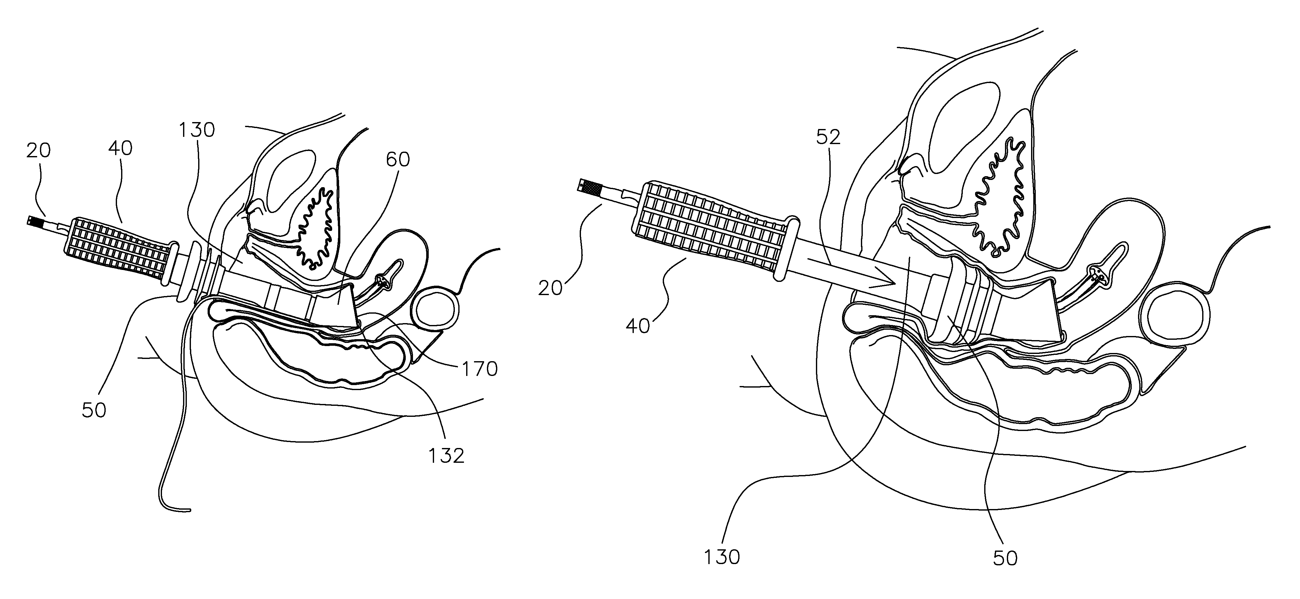Ergonomic, lighted uterine manipulator with cautery