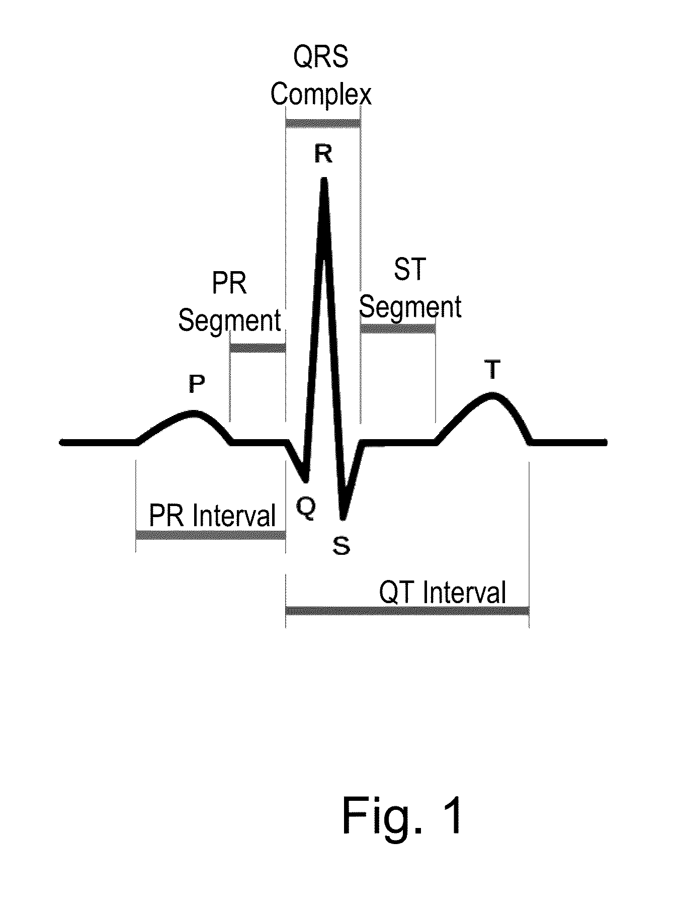 Method and system for detecting P-waves in the surface ECG signal