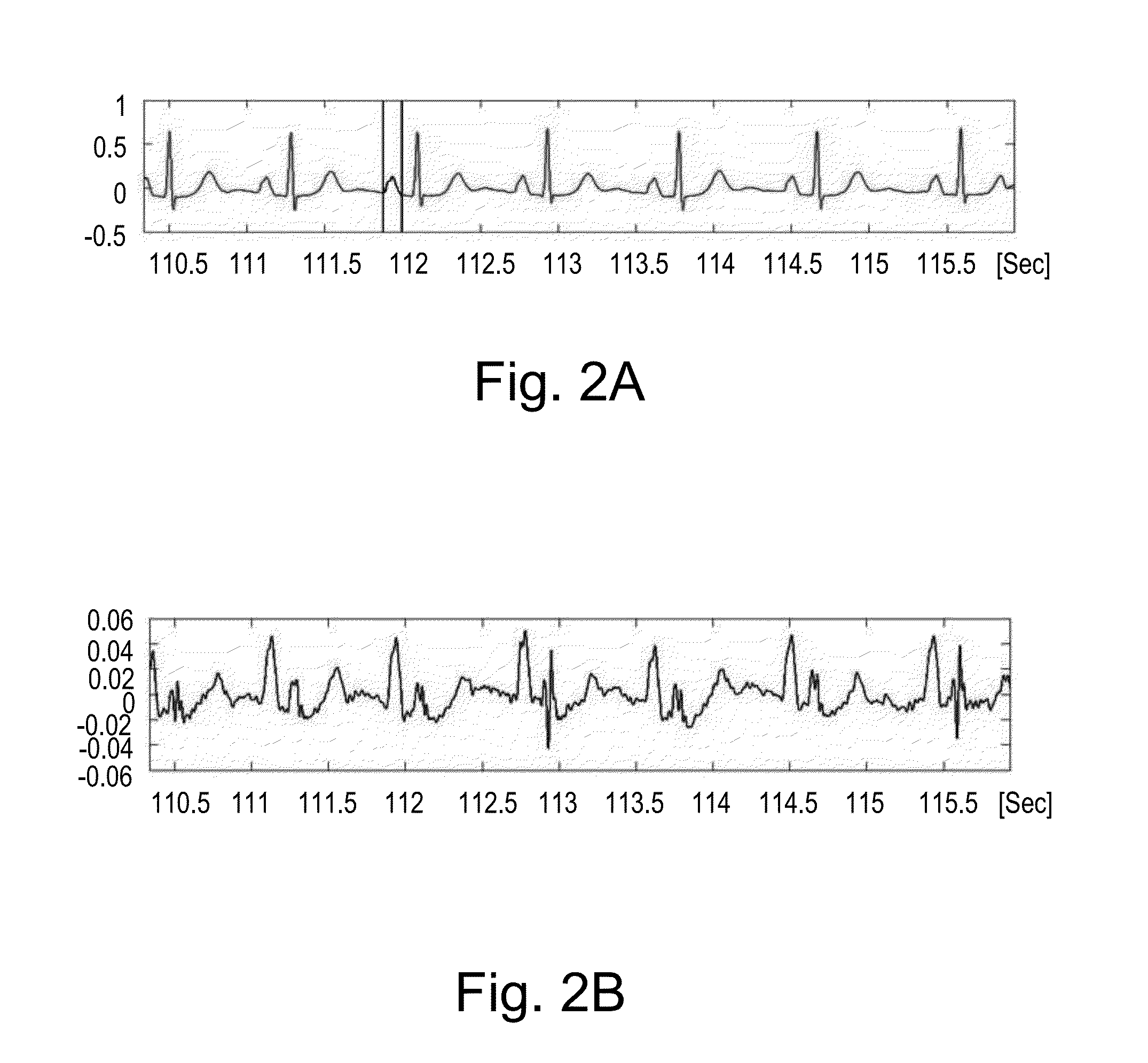 Method and system for detecting P-waves in the surface ECG signal