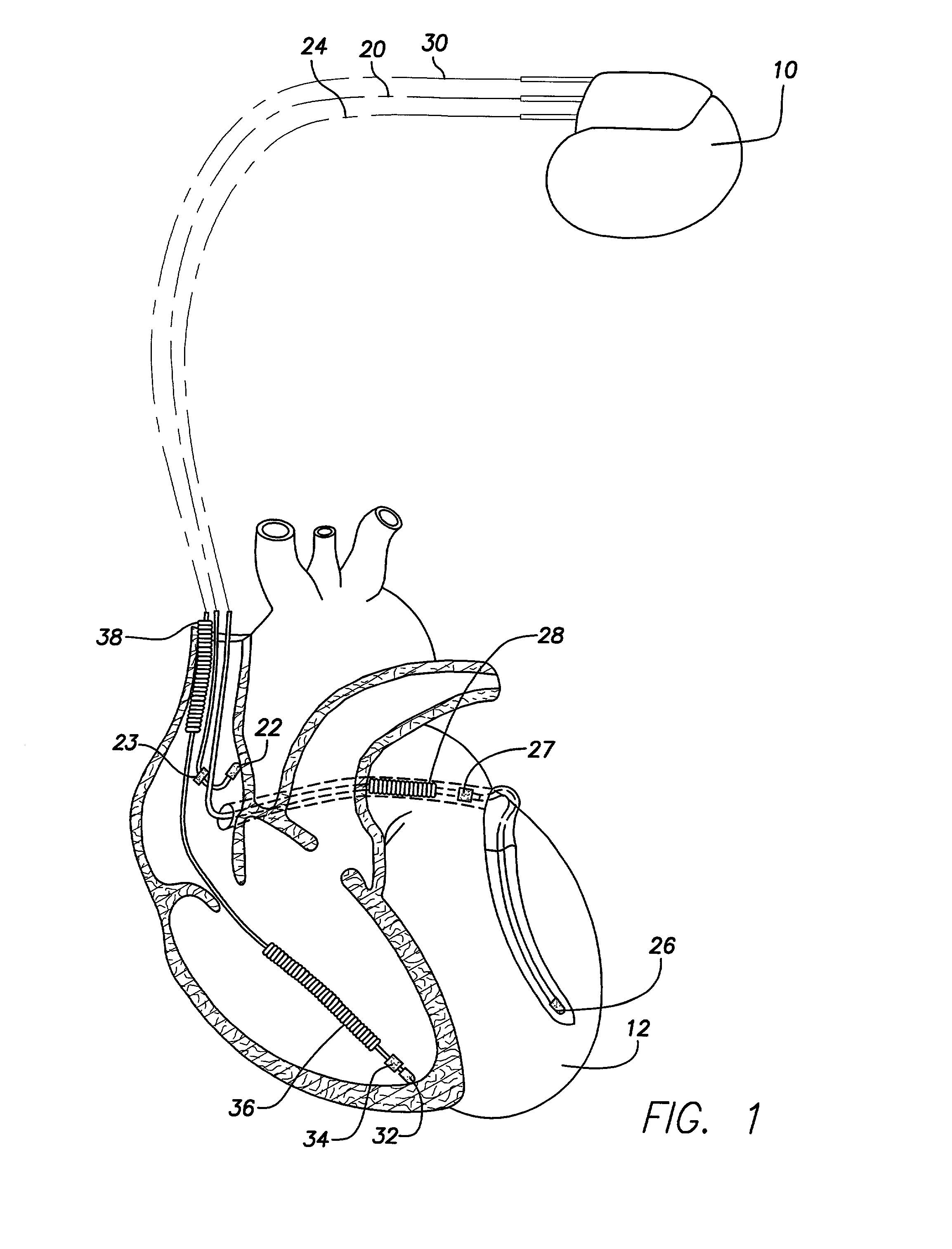 Method and device for enhanced capture tracking by discrimination of fusion beats