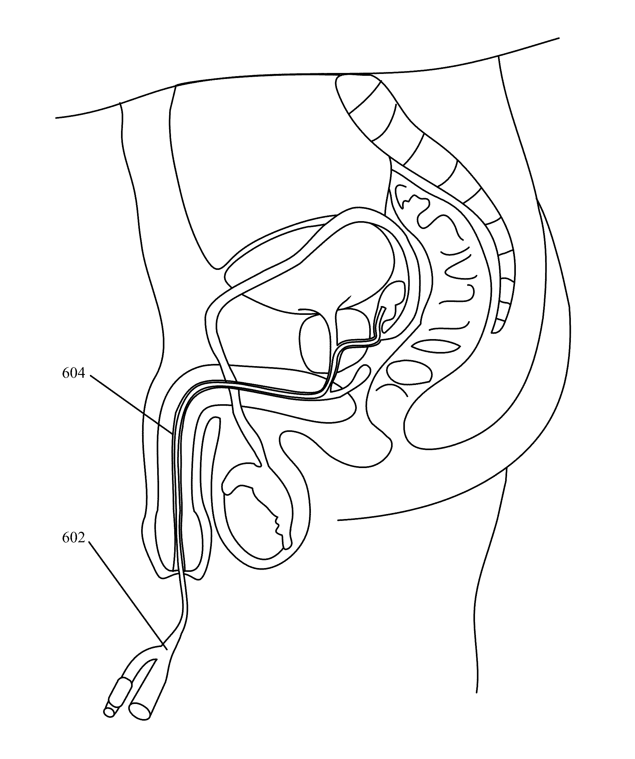 Implantable Drug Delivery Device and Methods of Treating Male Genitourinary and Surrounding Tissues