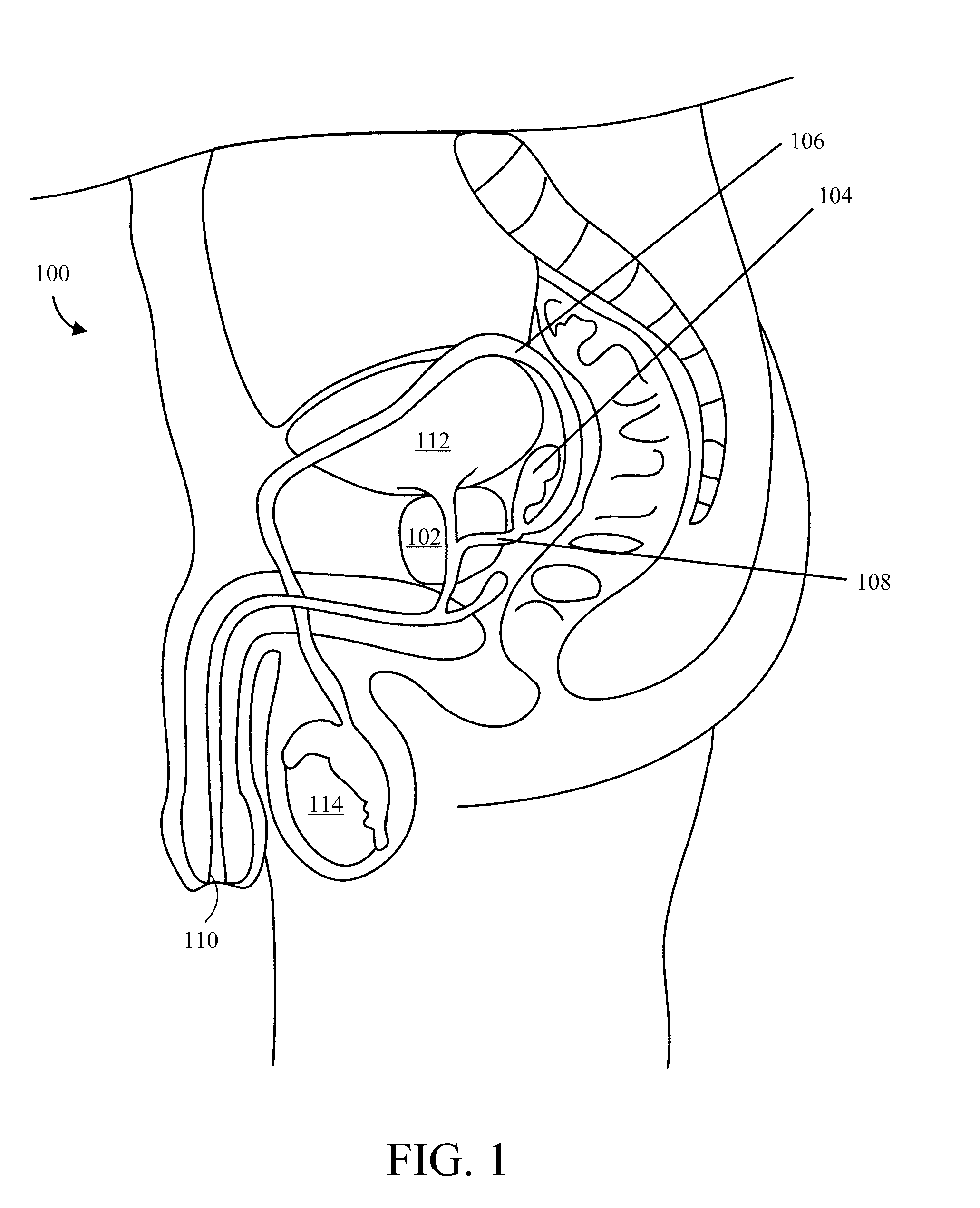 Implantable Drug Delivery Device and Methods of Treating Male Genitourinary and Surrounding Tissues