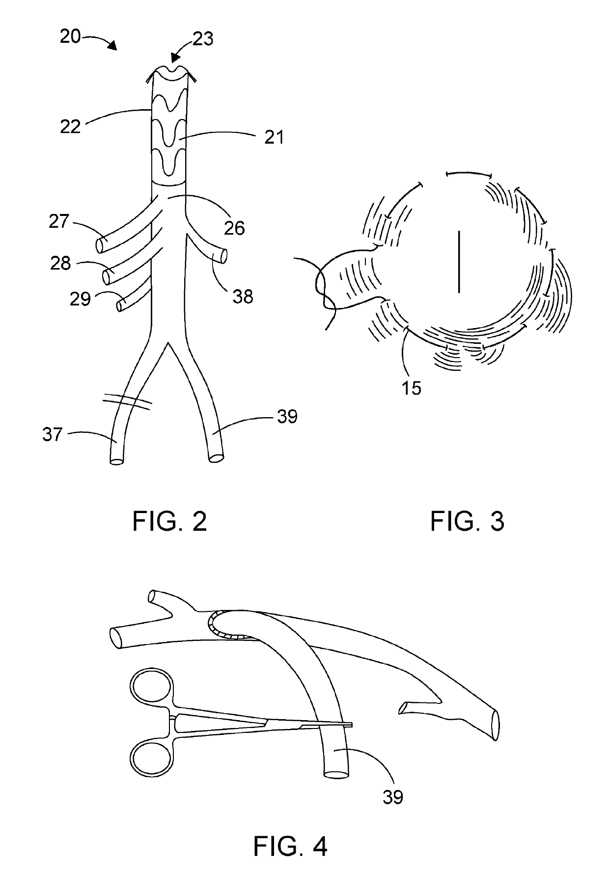 Hybrid prosthesis and delivery system