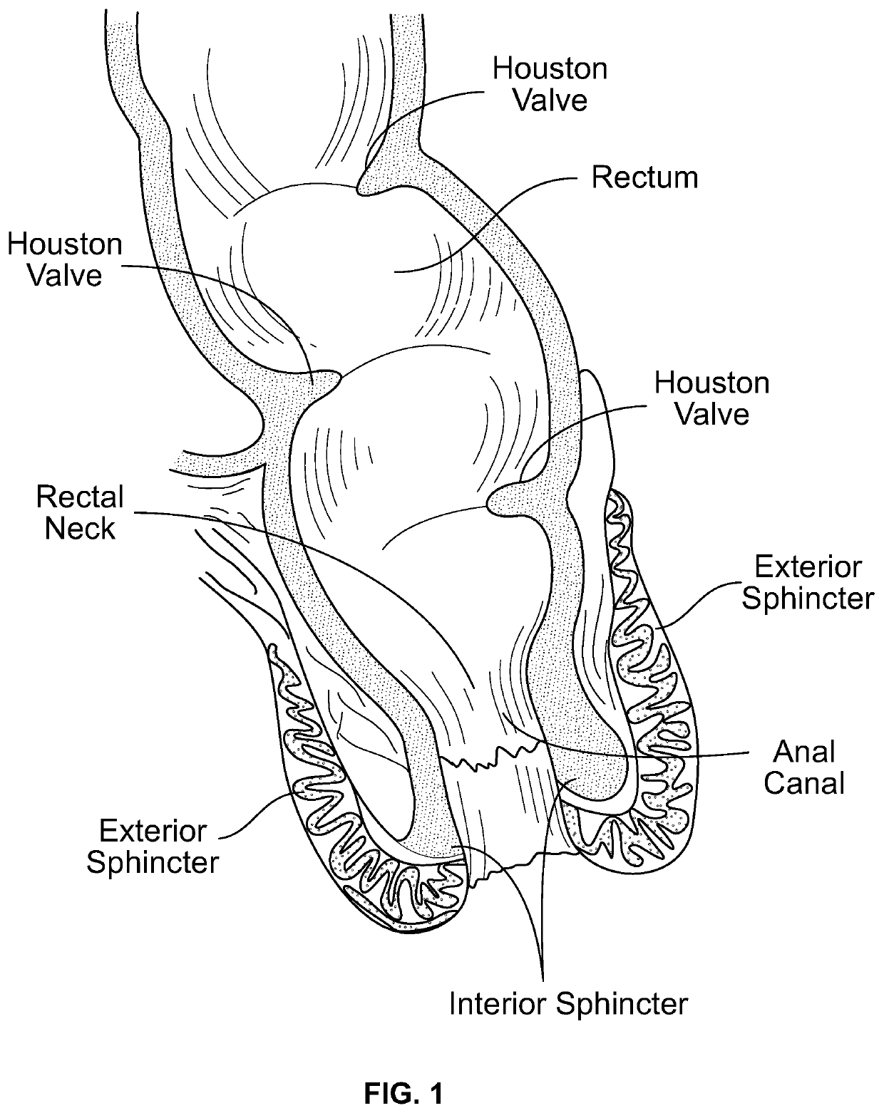 Device for controlling fecal incontinence