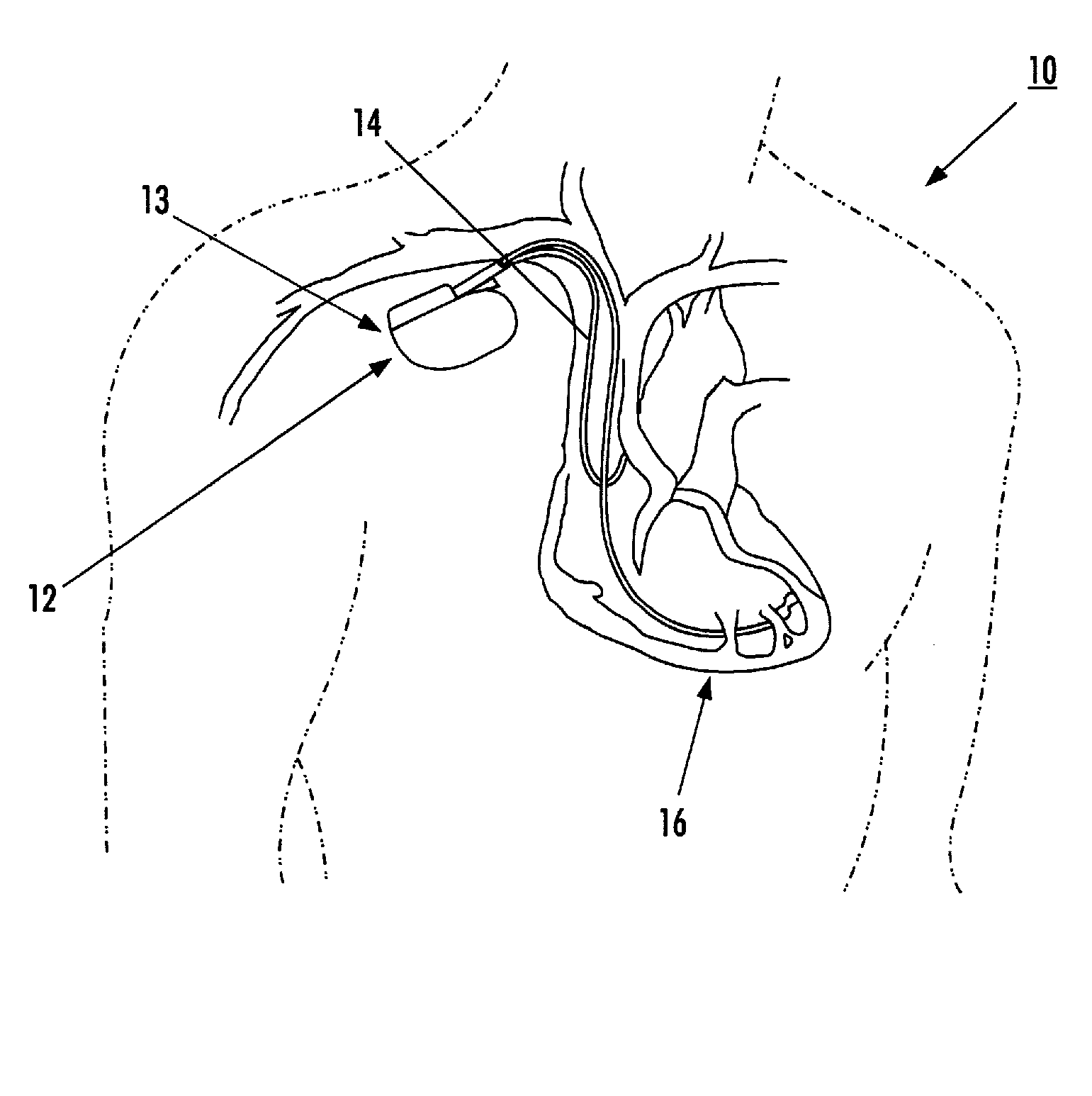 Resonance tuning module for implantable devices and leads