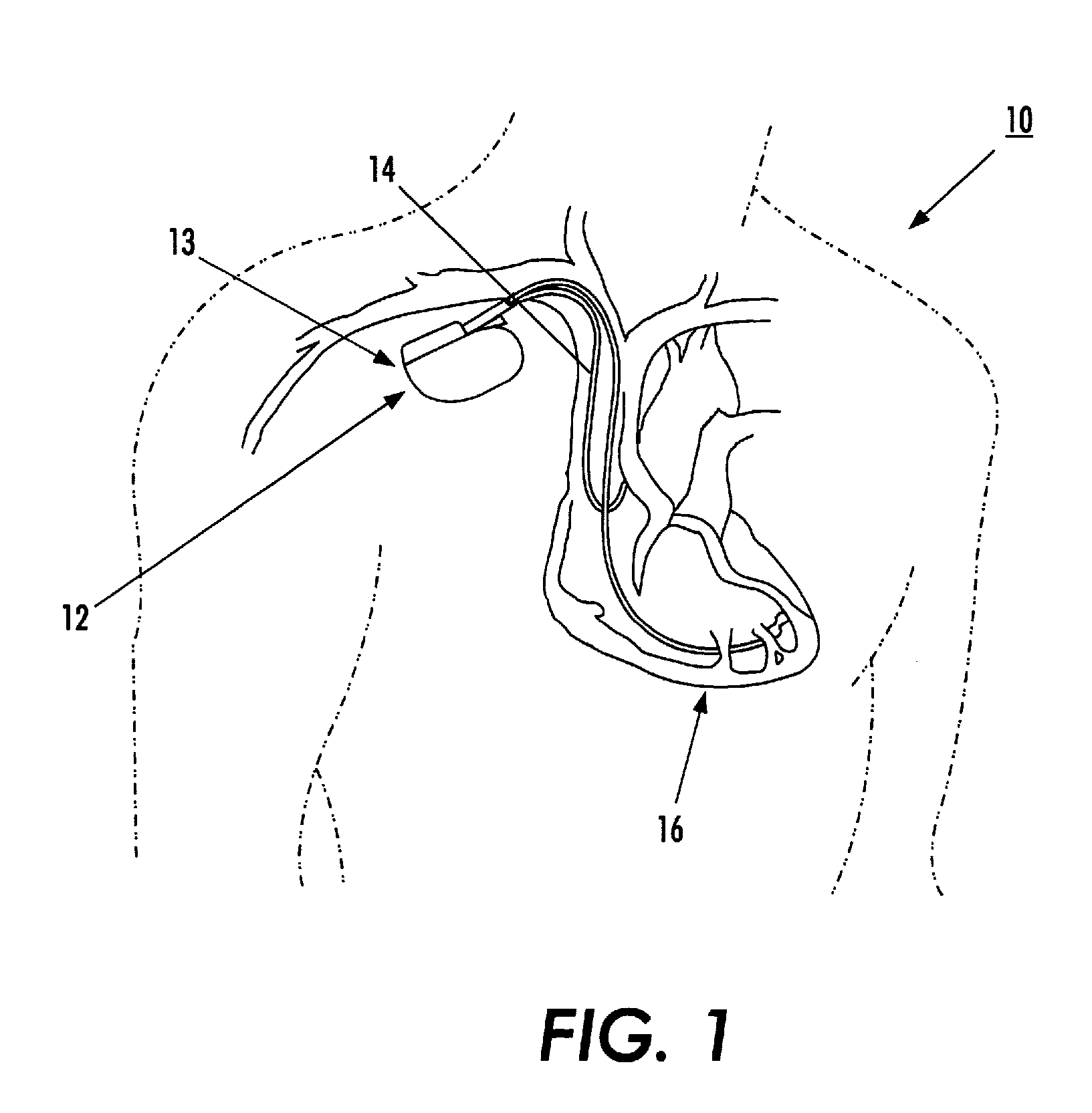 Resonance tuning module for implantable devices and leads