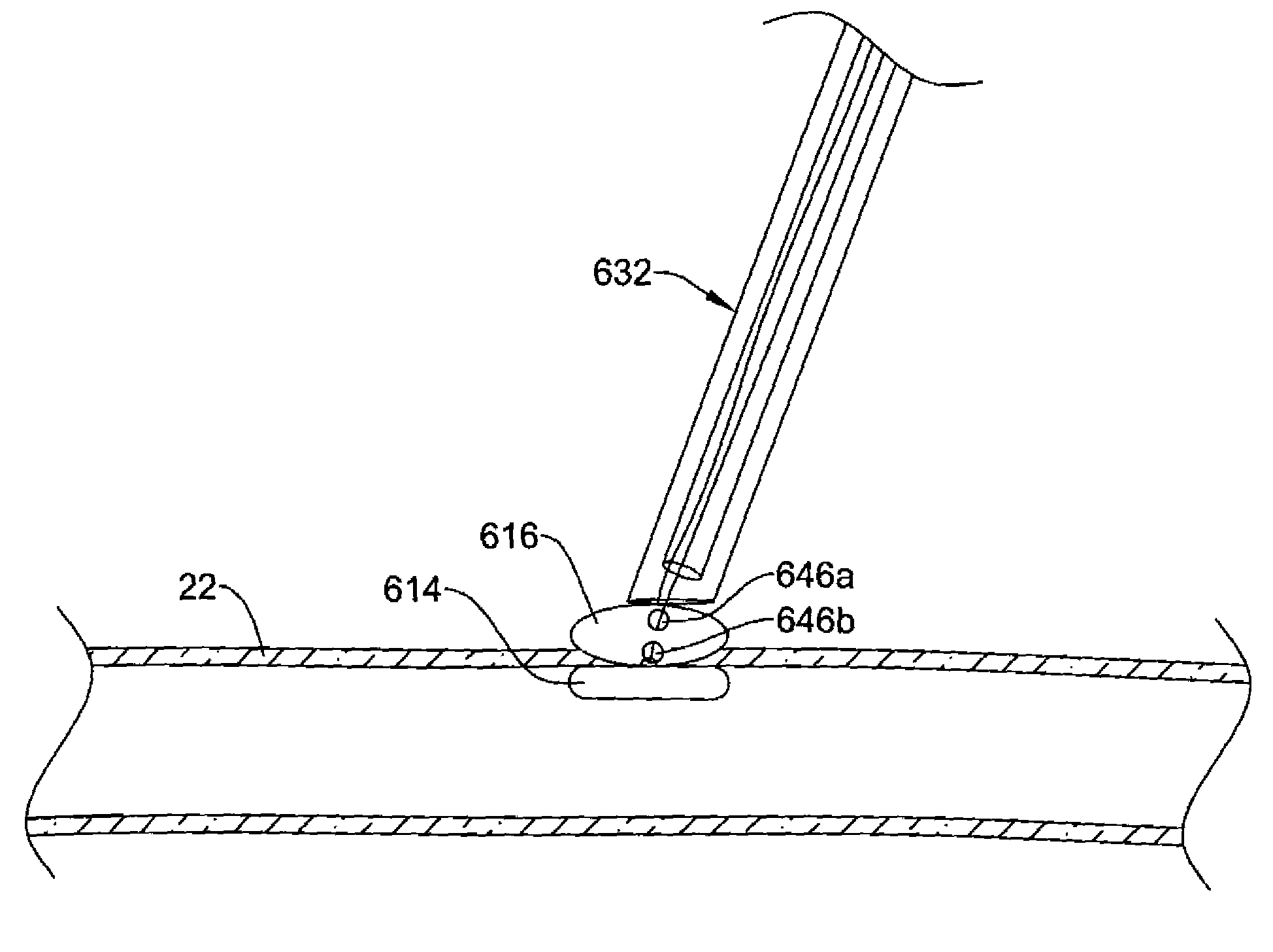 Closure device with rapidly dissolving anchor