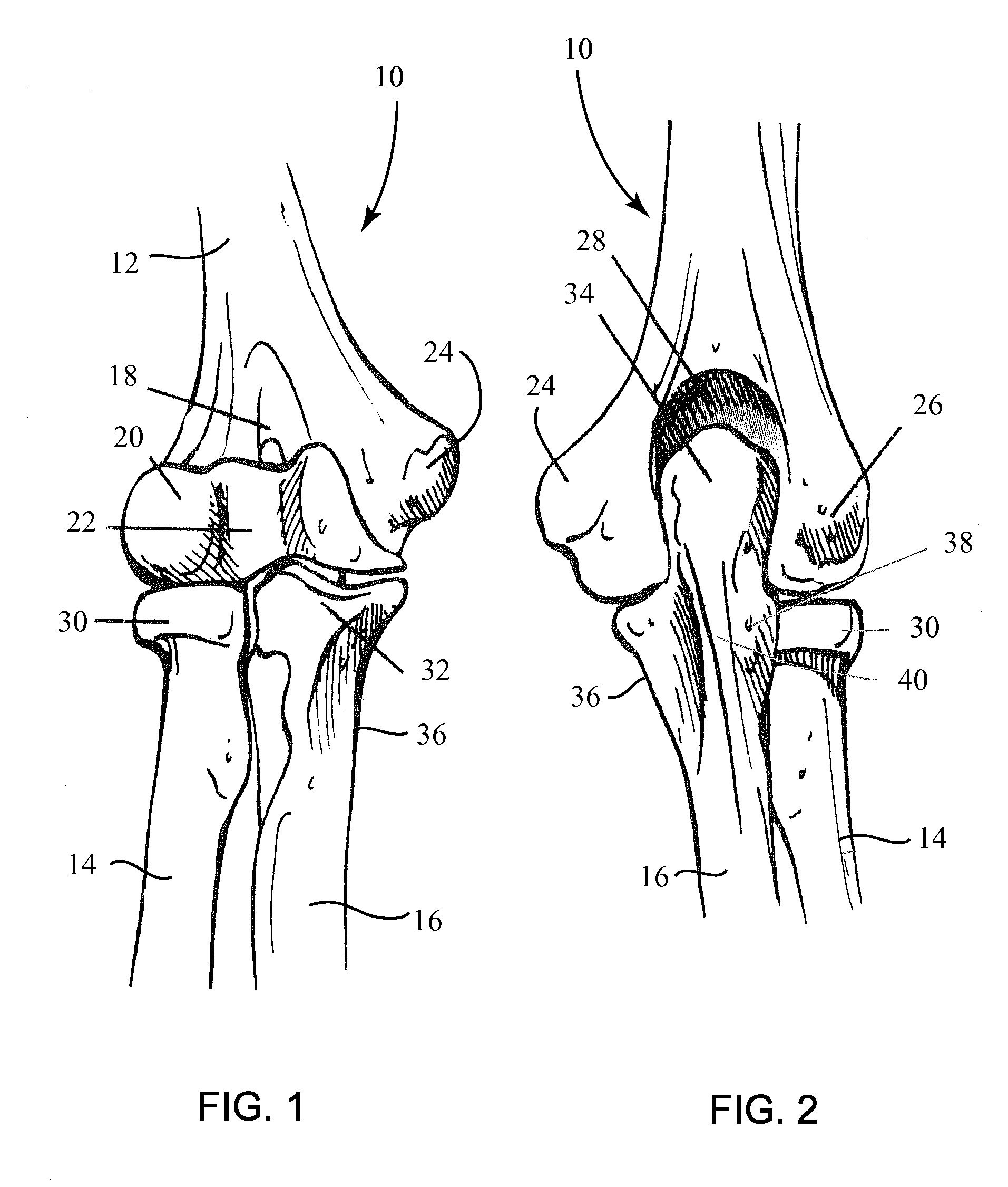 Fracture Fixation Plates for the Distal Humerus