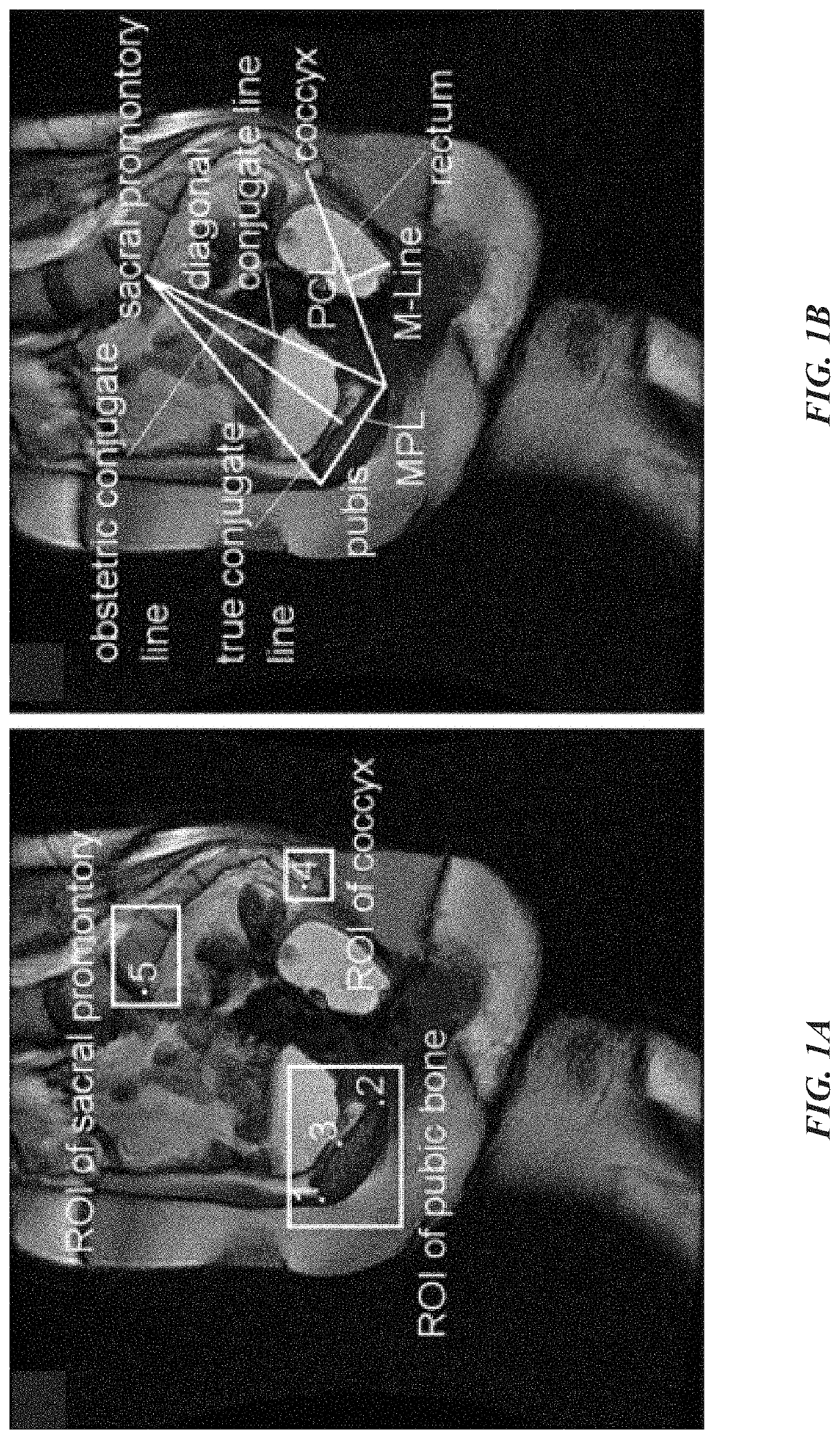 Image-based automated measurement model to predict pelvic organ prolapse