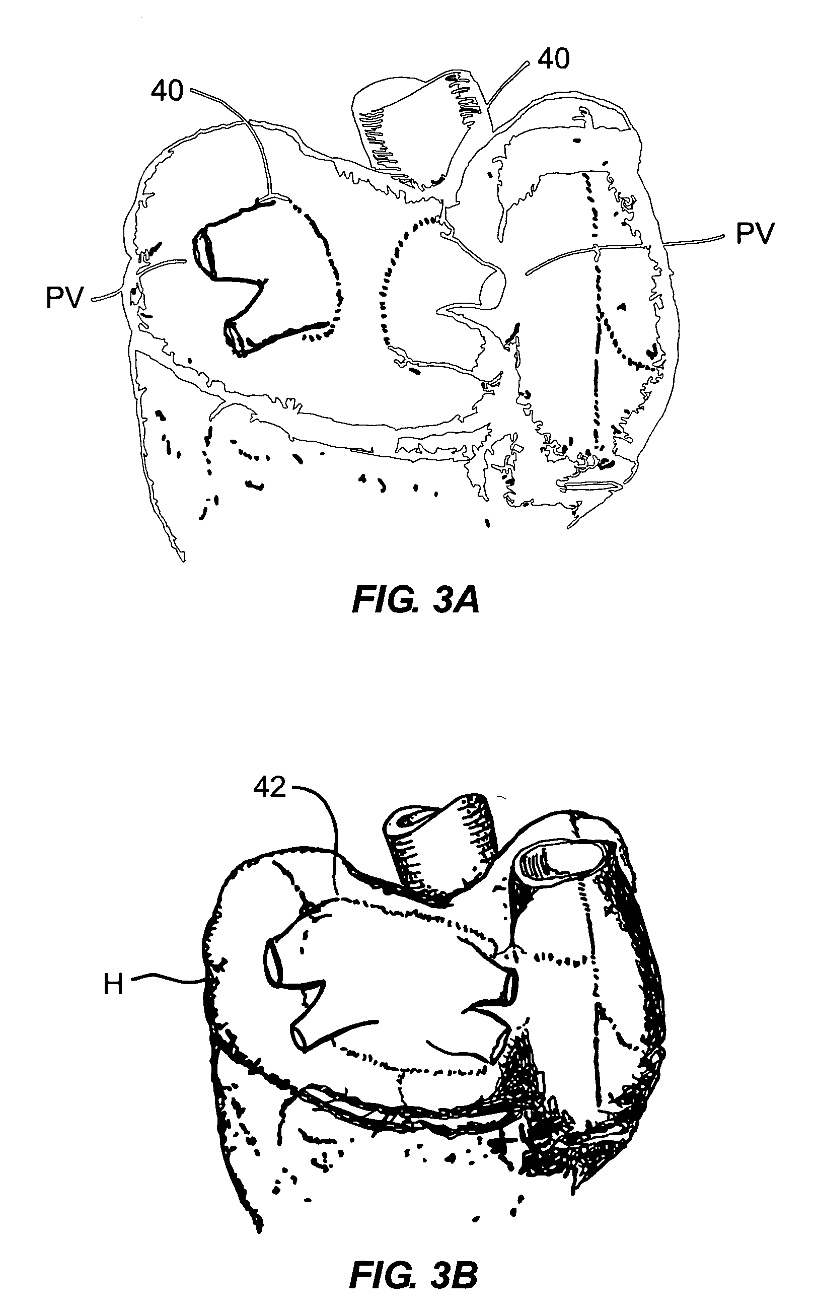System for non-invasive heart treatment
