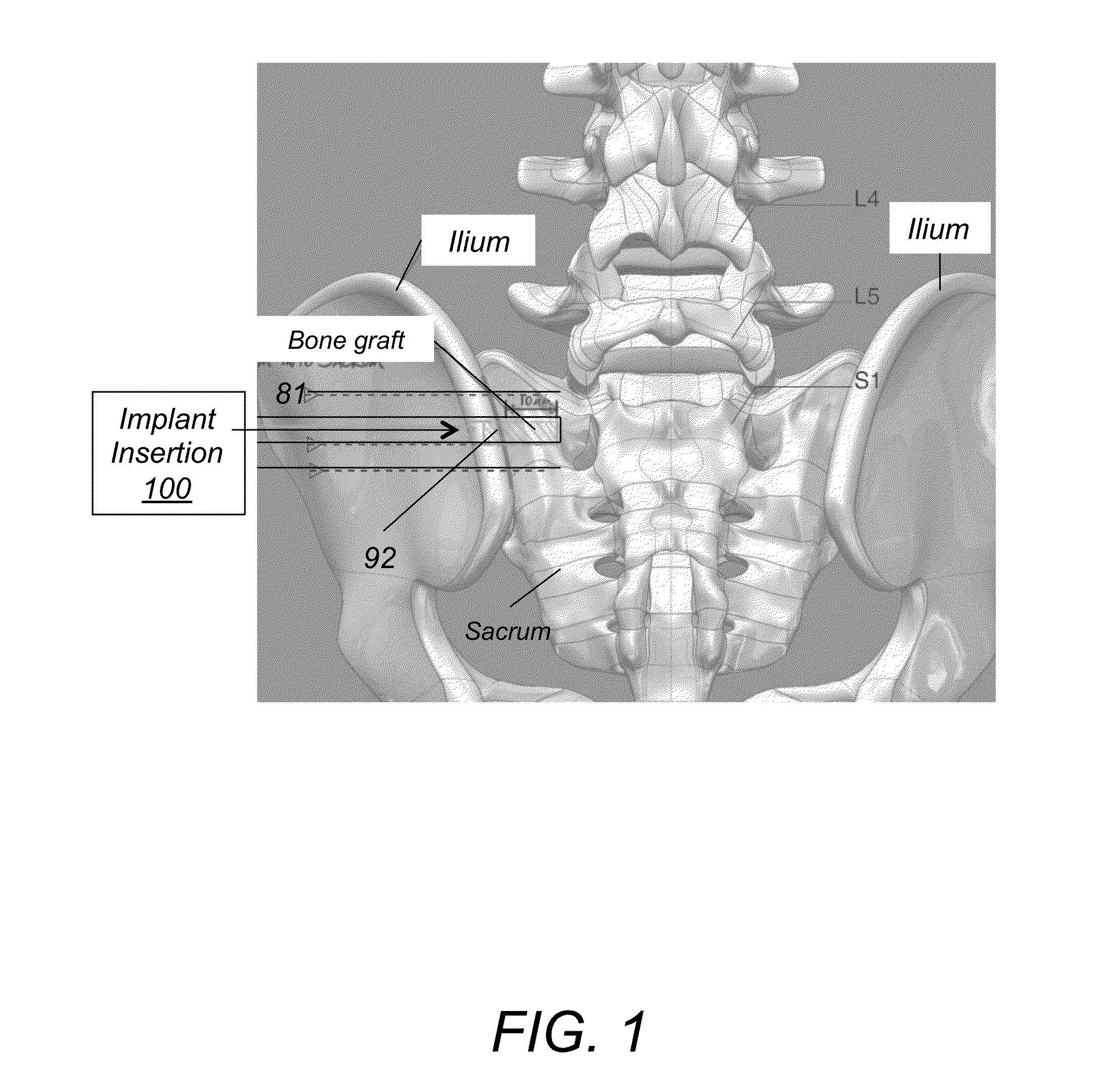 System AMD method for bone fusing implants and implant insertion tools