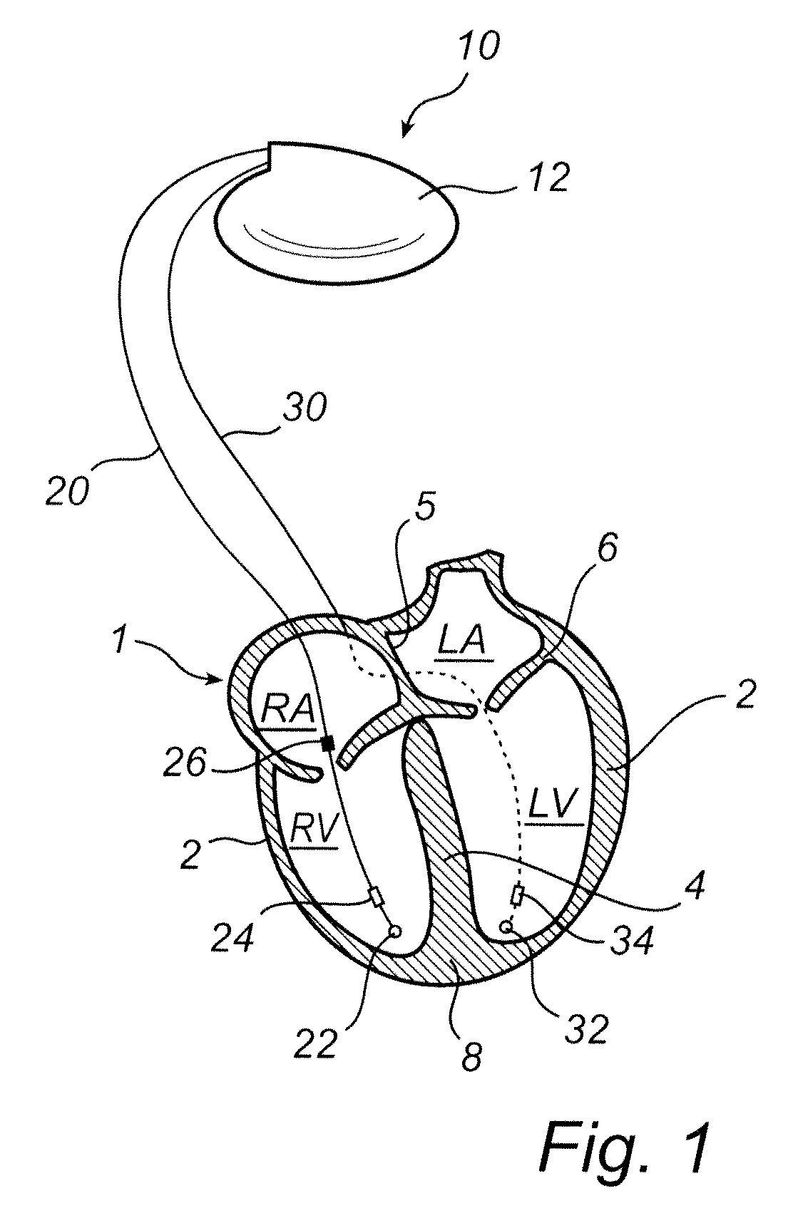 Implantable medical device and method for classifying arrhythmia events