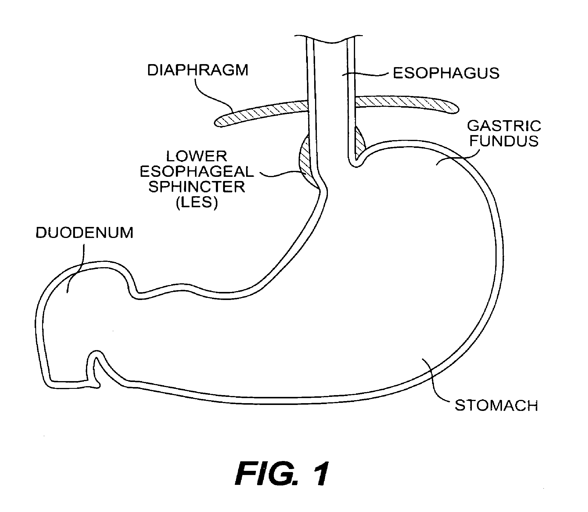 Methods and devices for folding and securing tissue