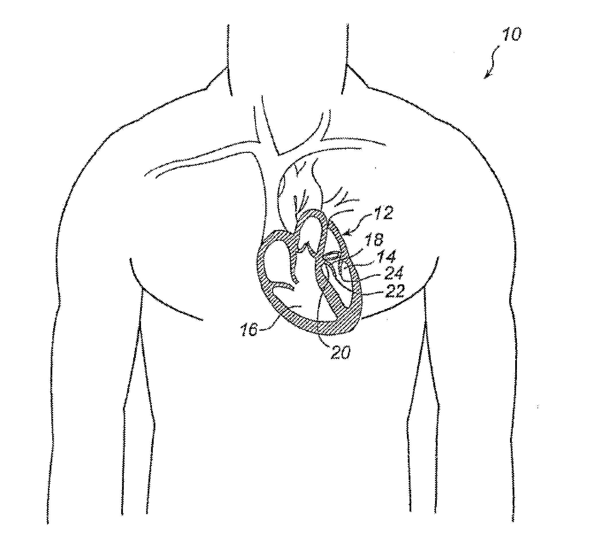 Device And Method For Improving Function Of Heart Valve