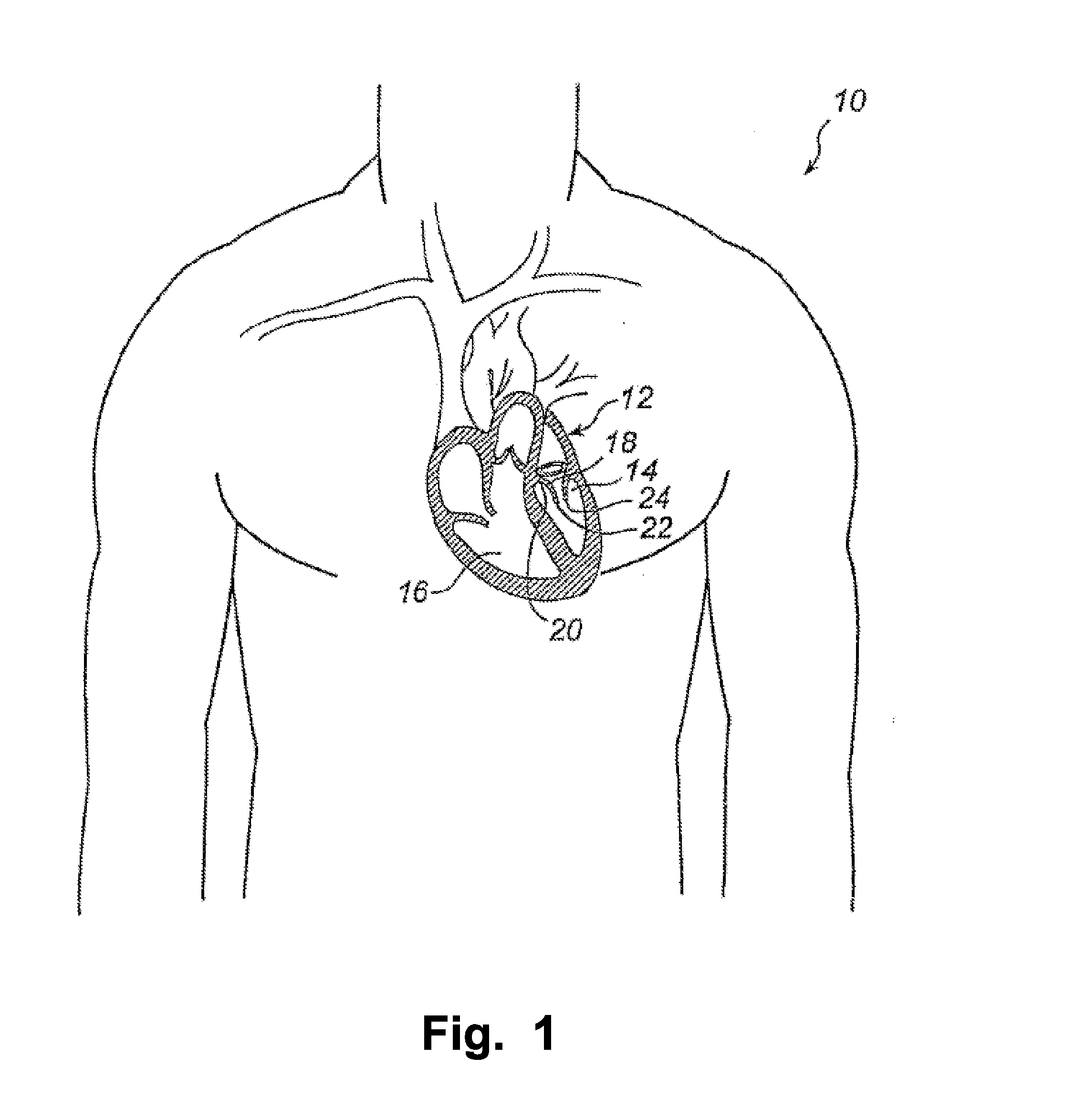 Device And Method For Improving Function Of Heart Valve