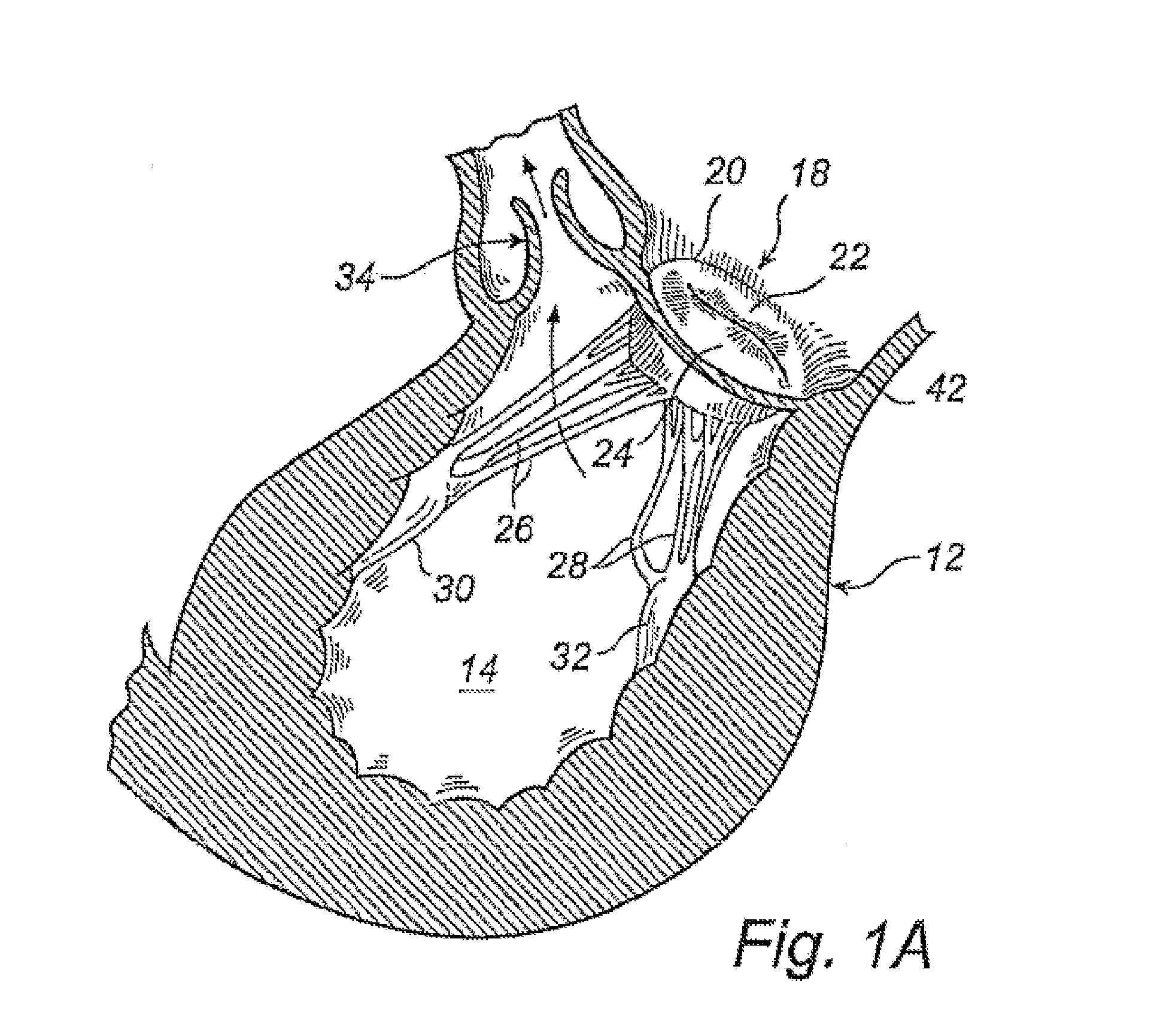 Device And Method For Improving Function Of Heart Valve