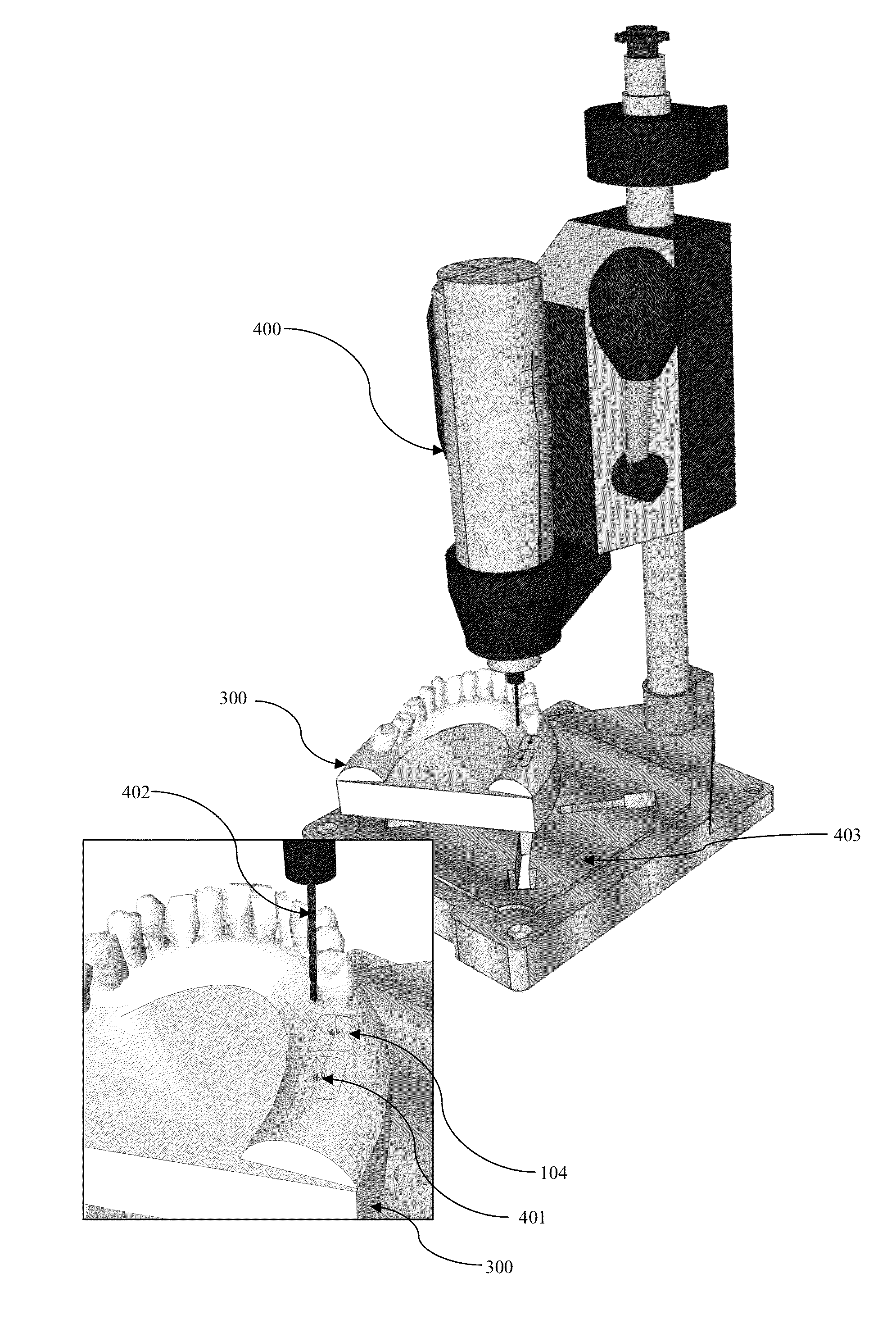 Surgical guide kit apparatus and method
