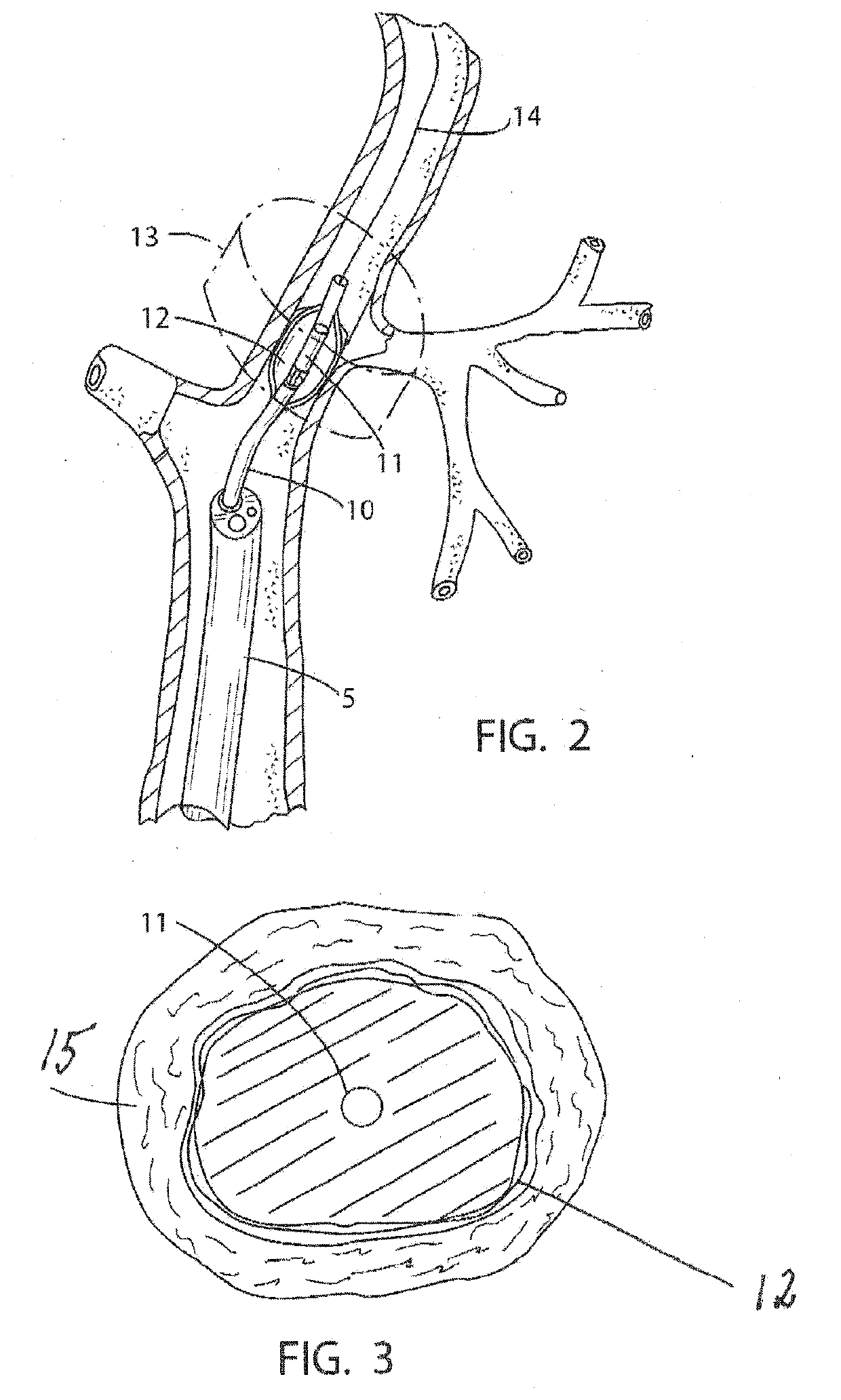 Method and apparatus for pulmonary interventions