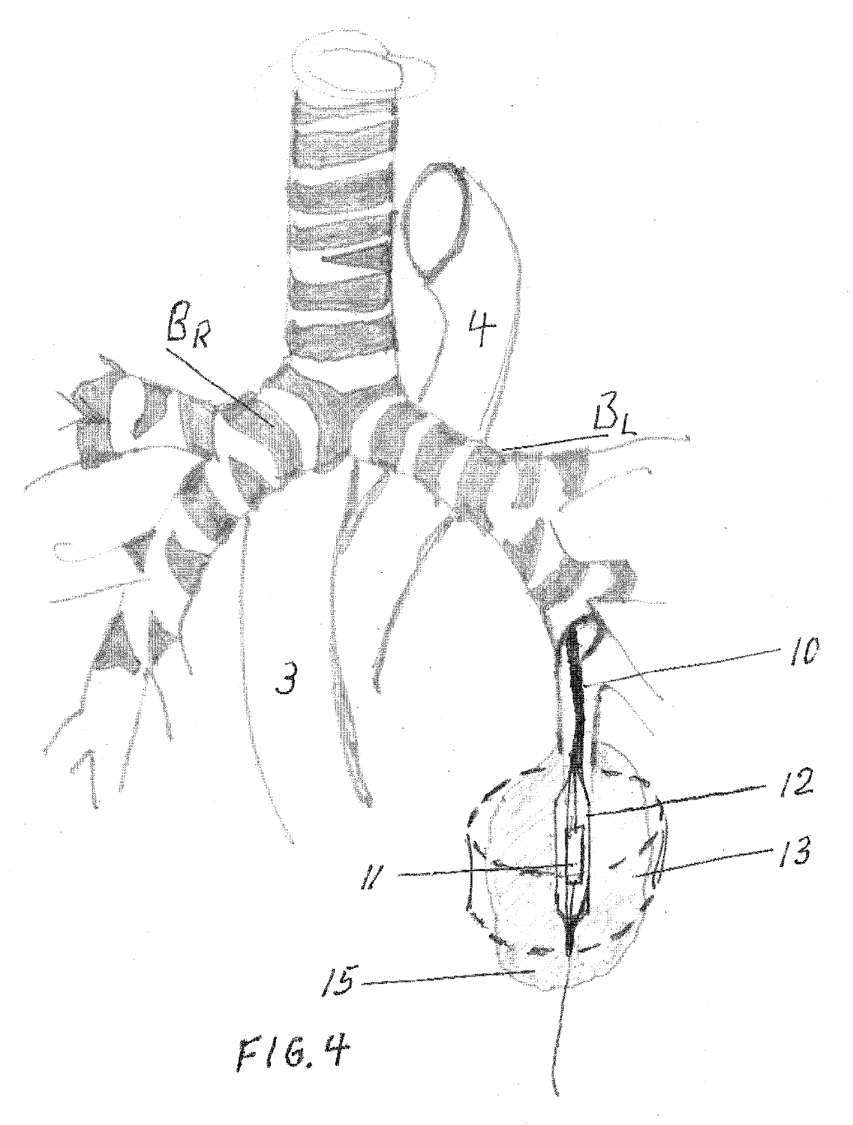 Method and apparatus for pulmonary interventions