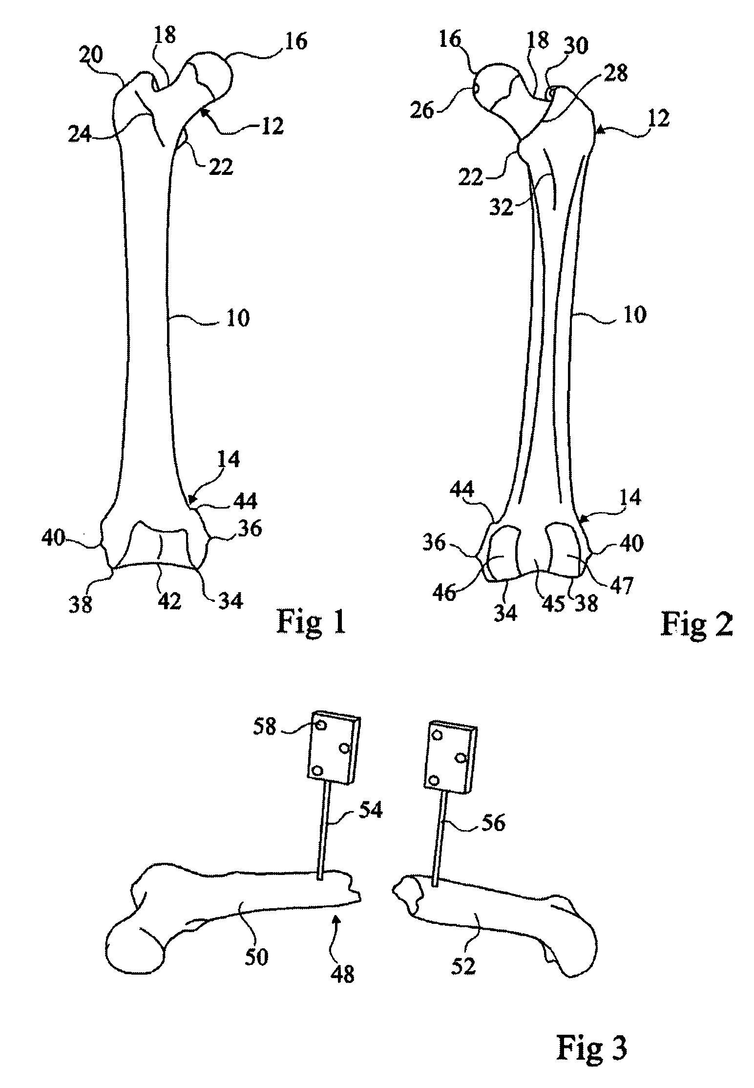 Method and system of computer assistance for the reduction of a fracture
