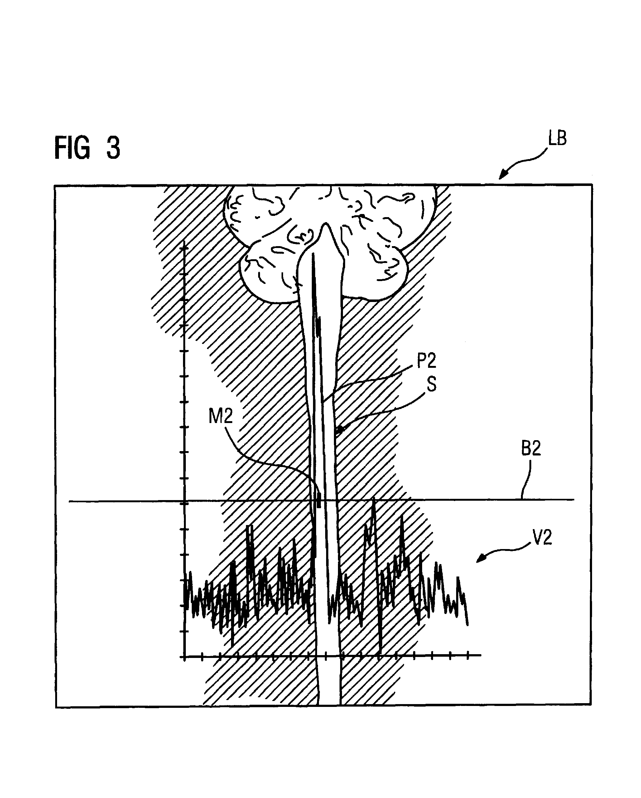 Method and magnetic resonance imaging apparatus for automatically determining the sagittal plane of a subject