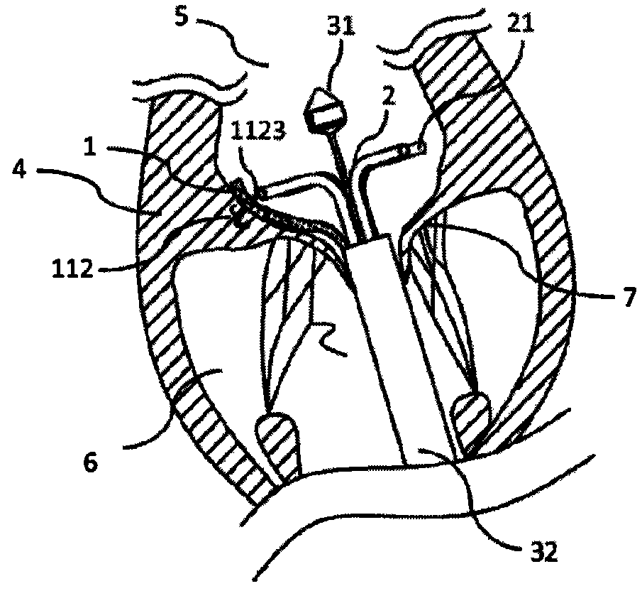 Repairing system provided with anchoring device and used for preventing valve regurgitation