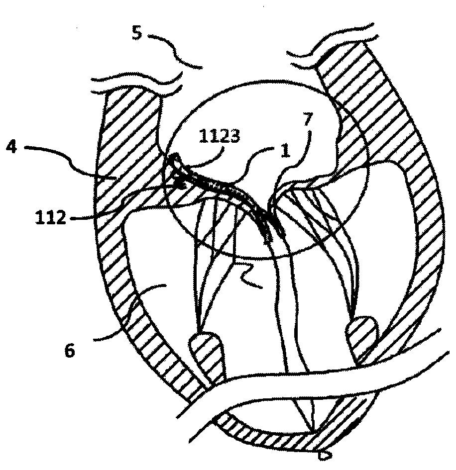 Repairing system provided with anchoring device and used for preventing valve regurgitation