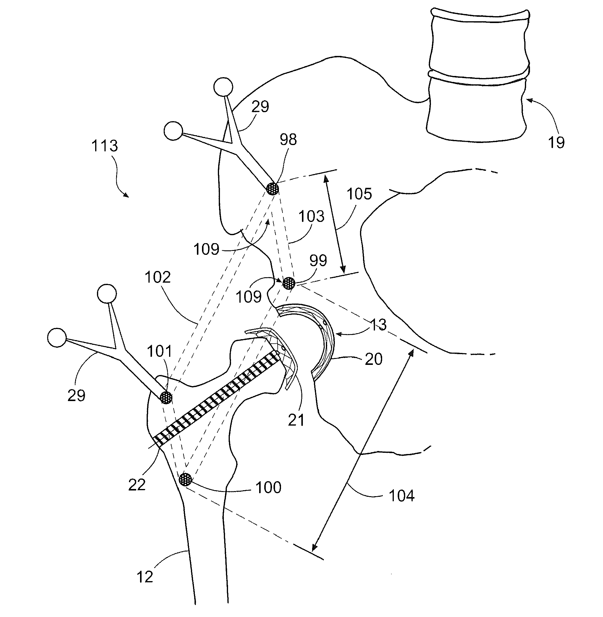 Method and apparatus for arthroscopic assisted arthroplasty of the hip joint