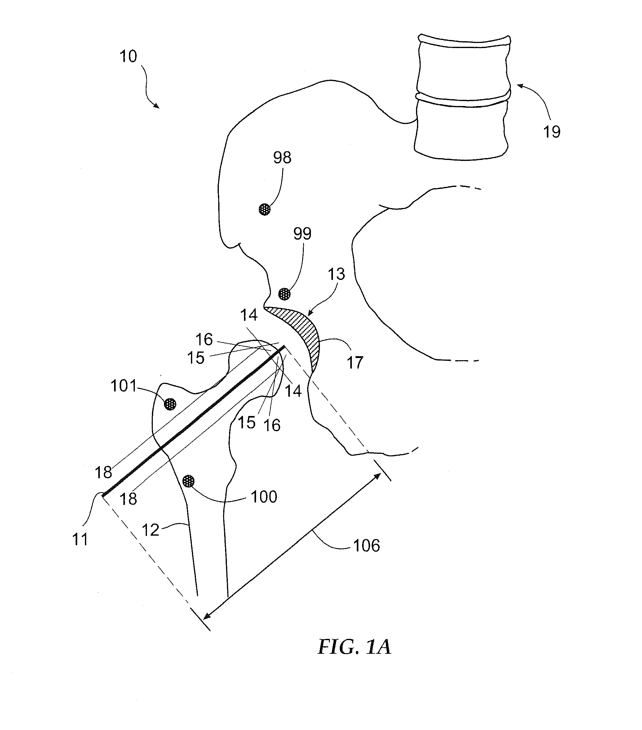 Method and apparatus for arthroscopic assisted arthroplasty of the hip joint