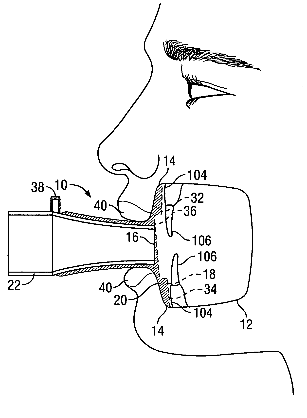 Respiratory mask having intraoral mouthpiece with large sealing area and multiple sealing configuration