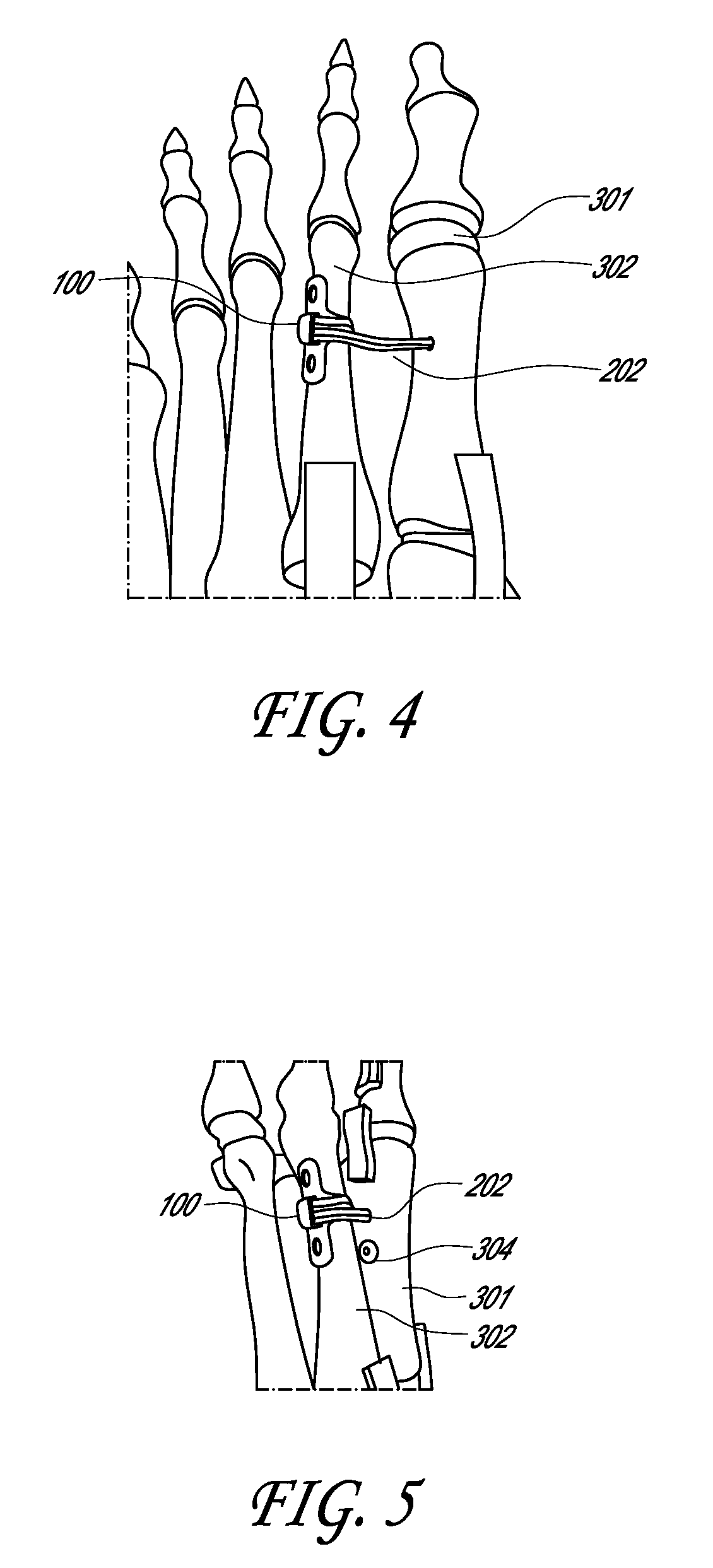 Method and device for reducing angular bone deformity using a bone stabilization plate and cerclage material