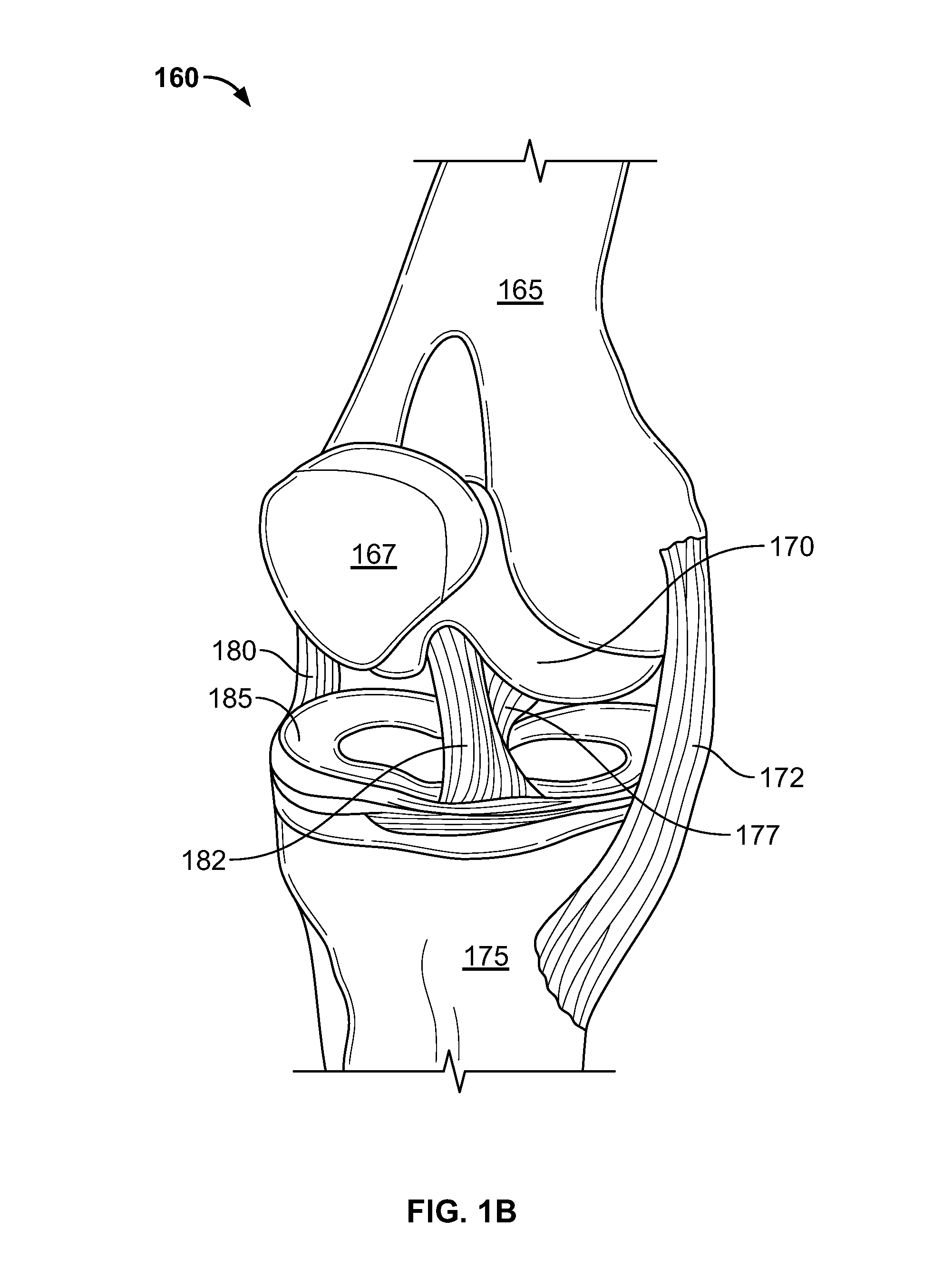 Systems and methods for treating human joints