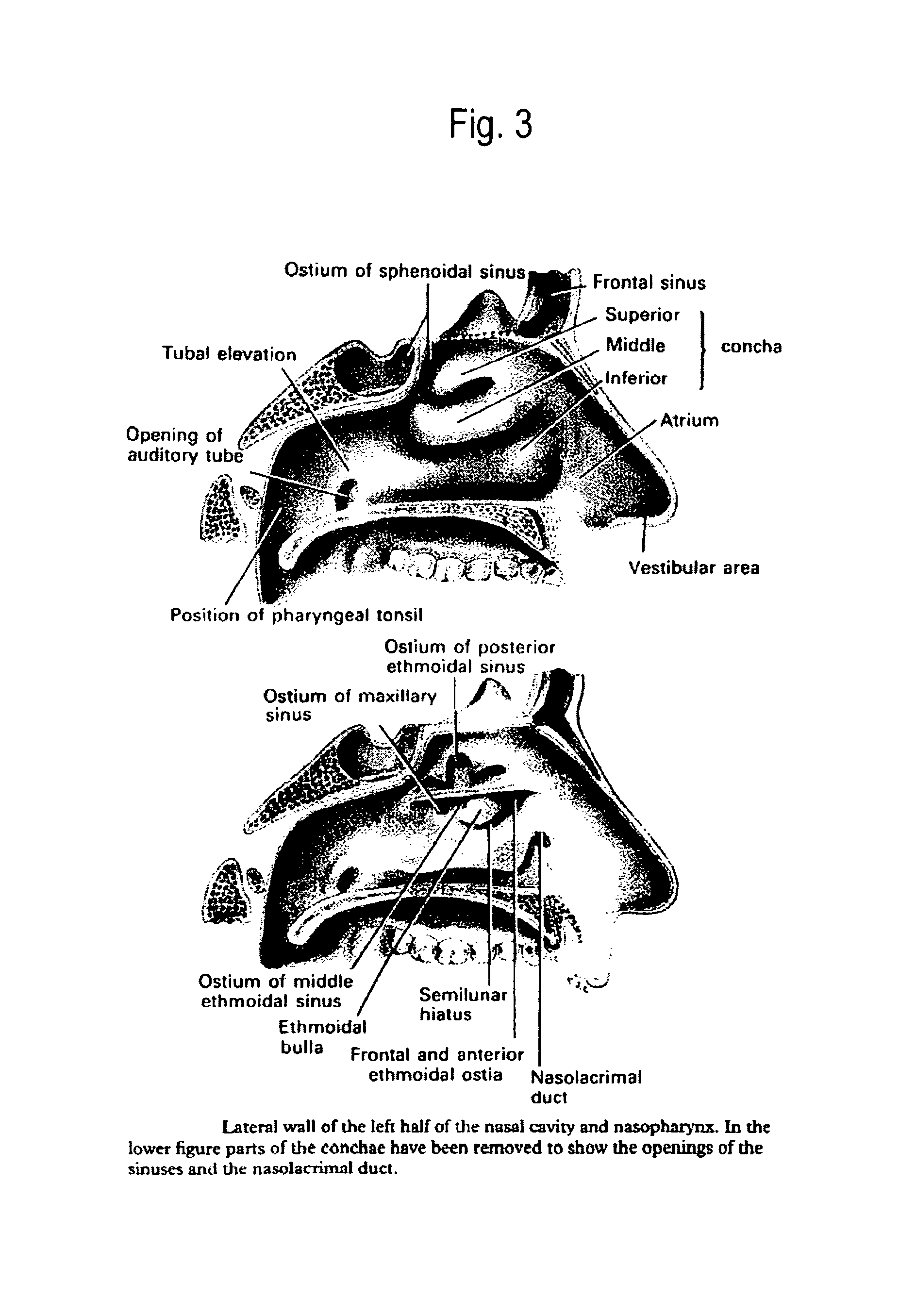 Method of collecting nasopharyngeal cells and secretions for diagnosis of viral upper respiratory infections and screening for nasopharyngeal cancer