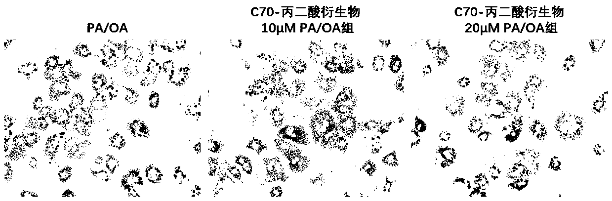 Application of malonic-acid-modified fullerene C70 in preparation of medicine for treating non-alcoholic fatty liver disease