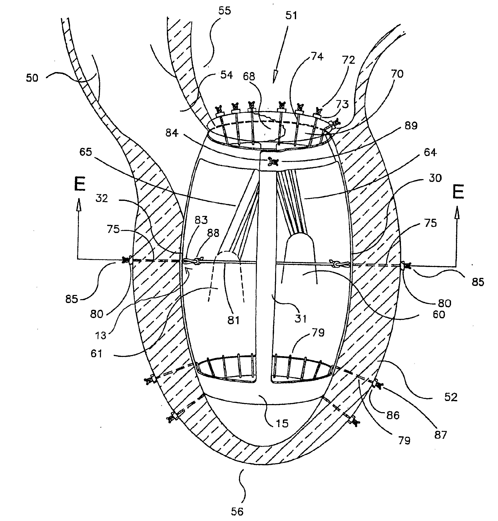 Method and Apparaus for the Surgical Treatment of Congestive Heart Failure