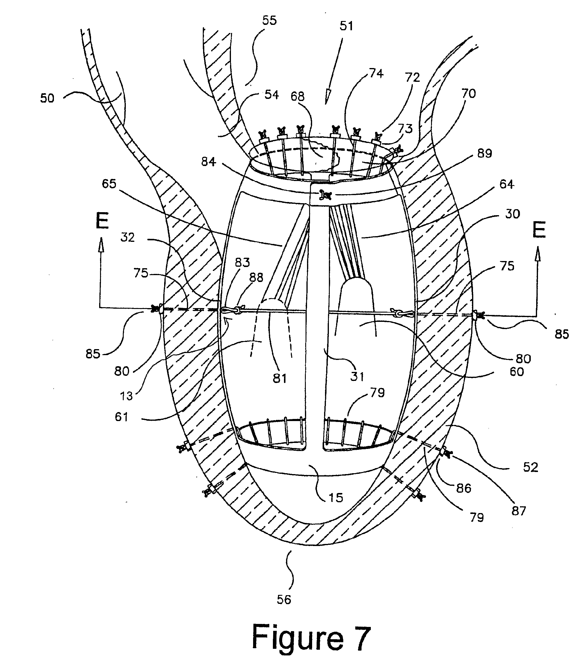 Method and Apparaus for the Surgical Treatment of Congestive Heart Failure