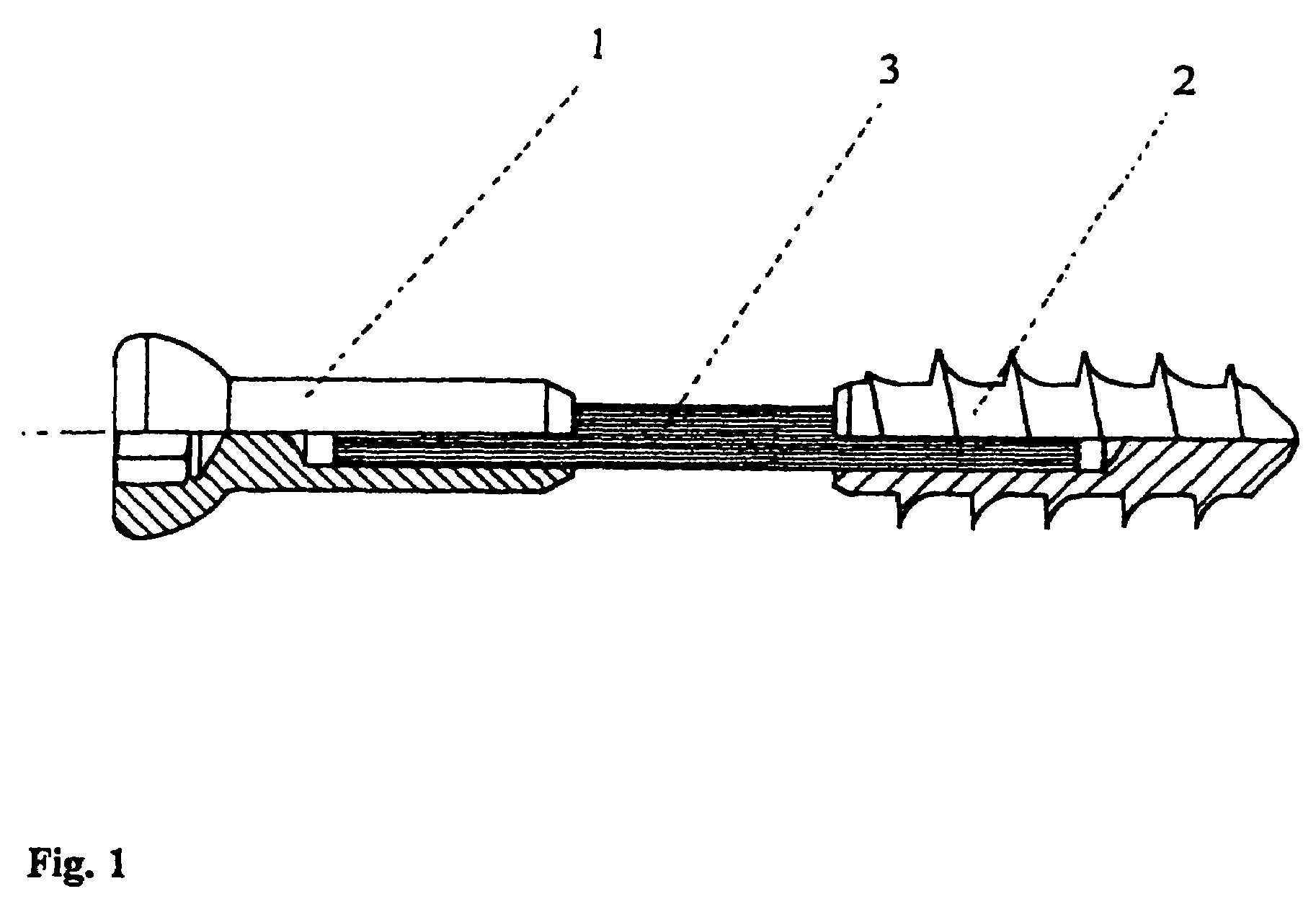 Implantable screw for stabilization of a joint or a bone fracture