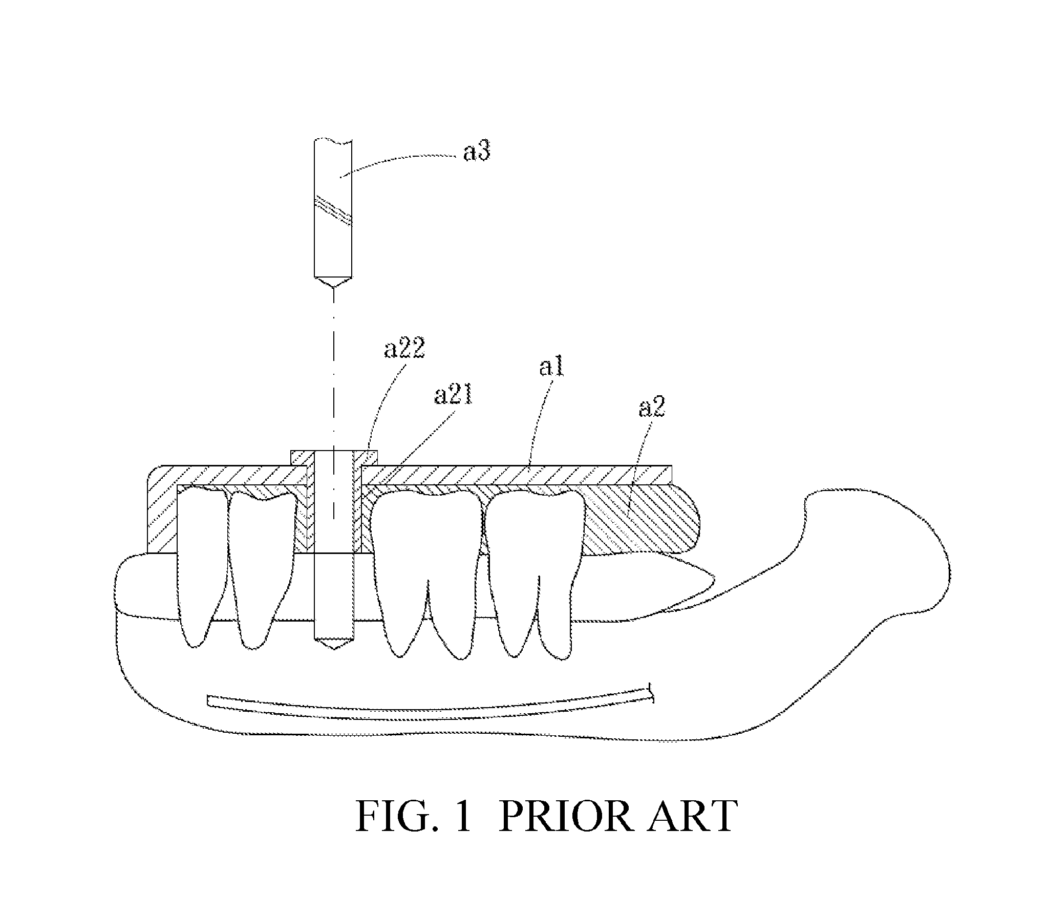 Dental positioning stent, and manufacturing method, using method and components for the same