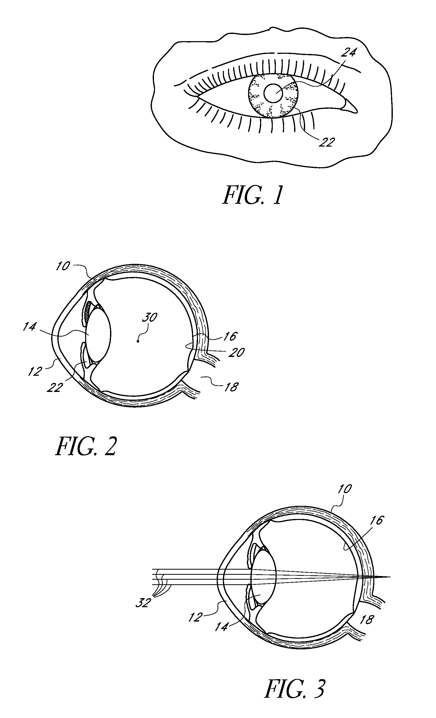 Corneal inlay with nutrient transport structures