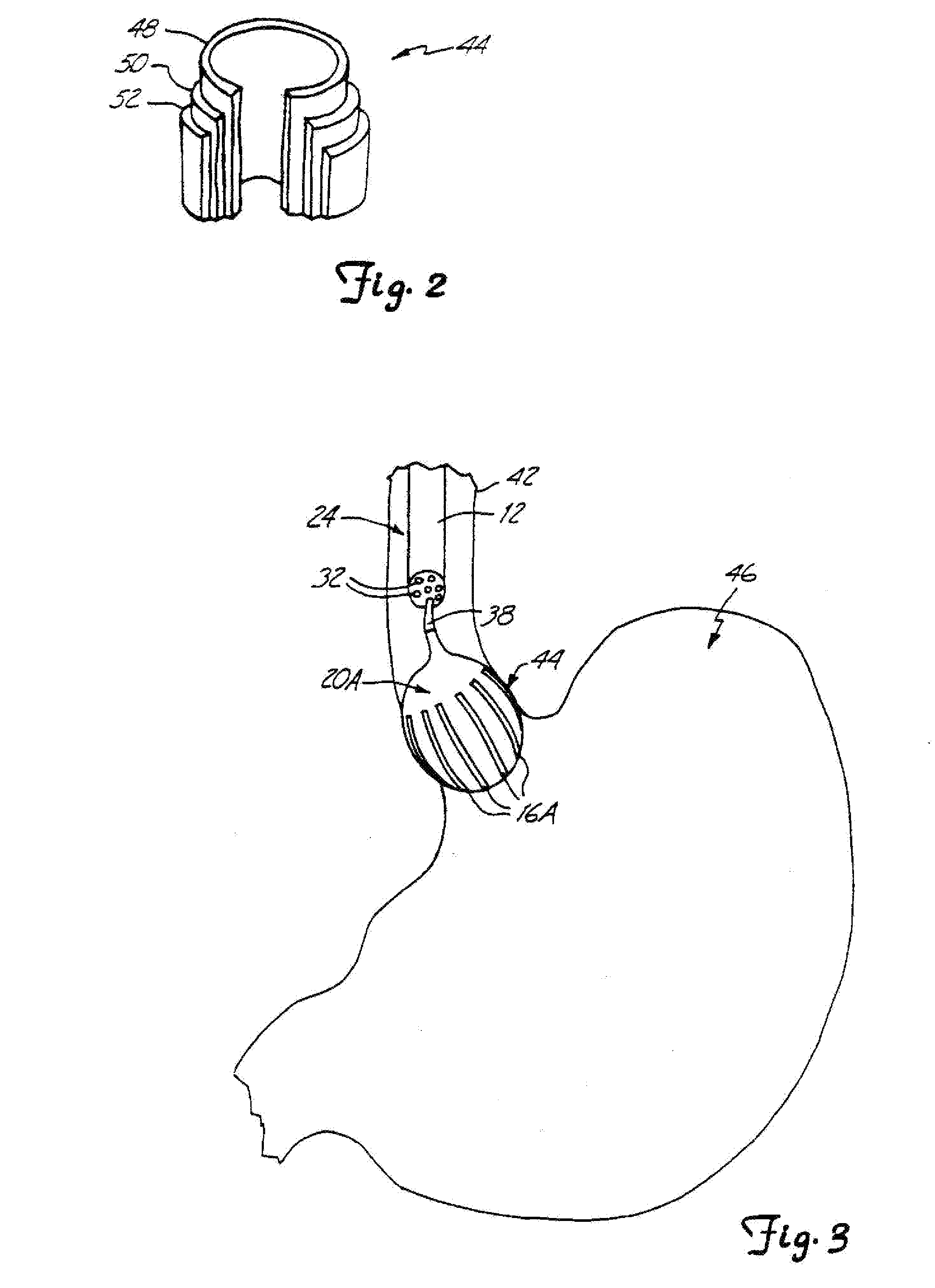 Device and method for treatment of gastroesophageal reflux disease