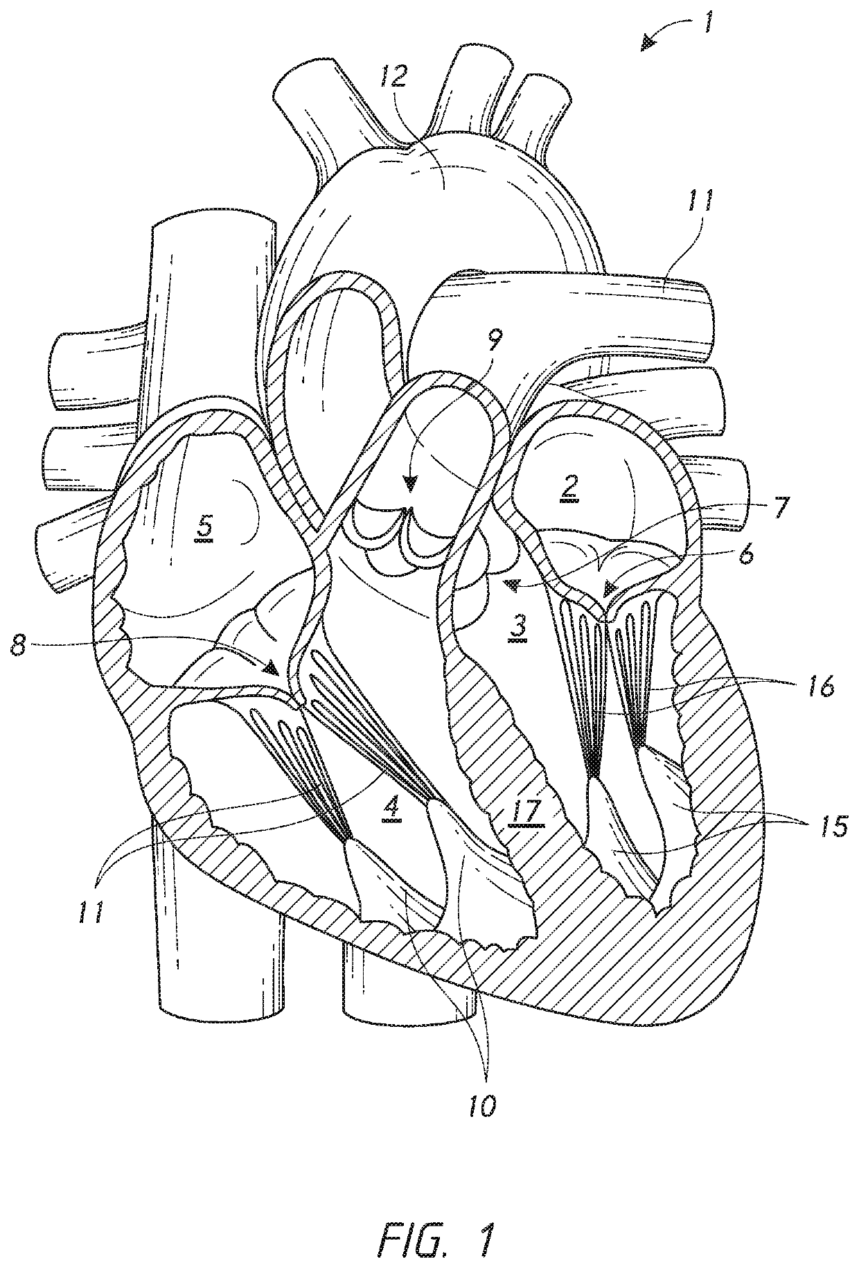 Chordae tendineae adjustment