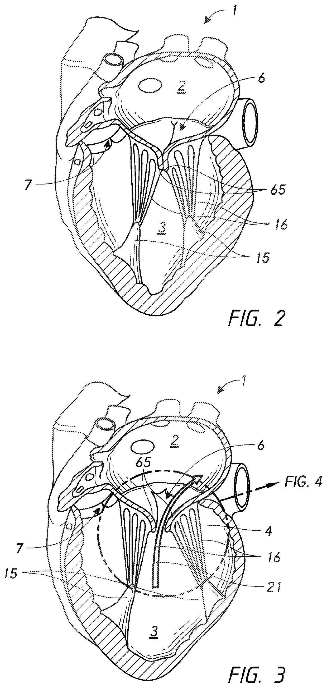 Chordae tendineae adjustment