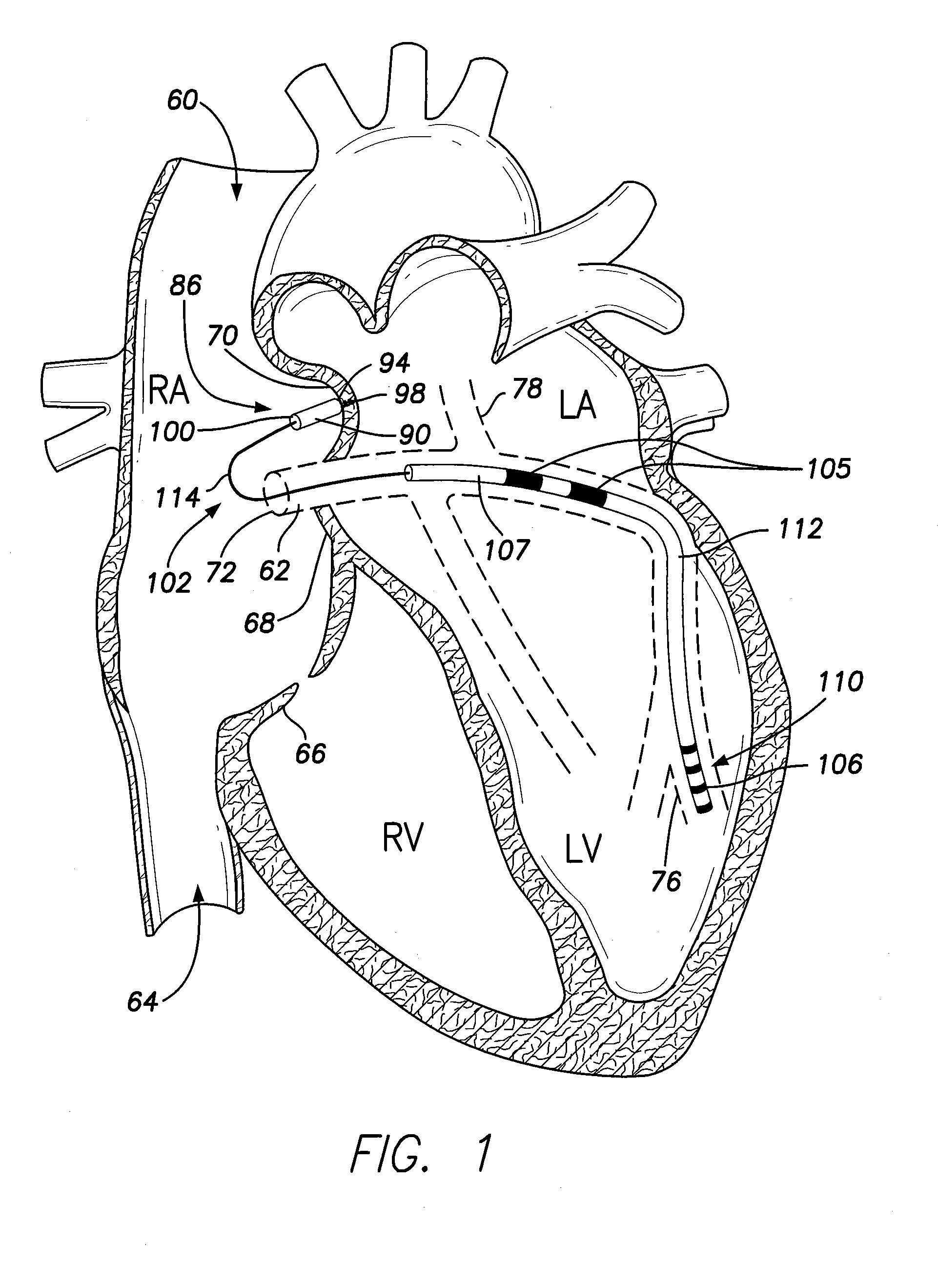 Intra-cardiac implantable medical device with IC device extension for lv pacing/sensing