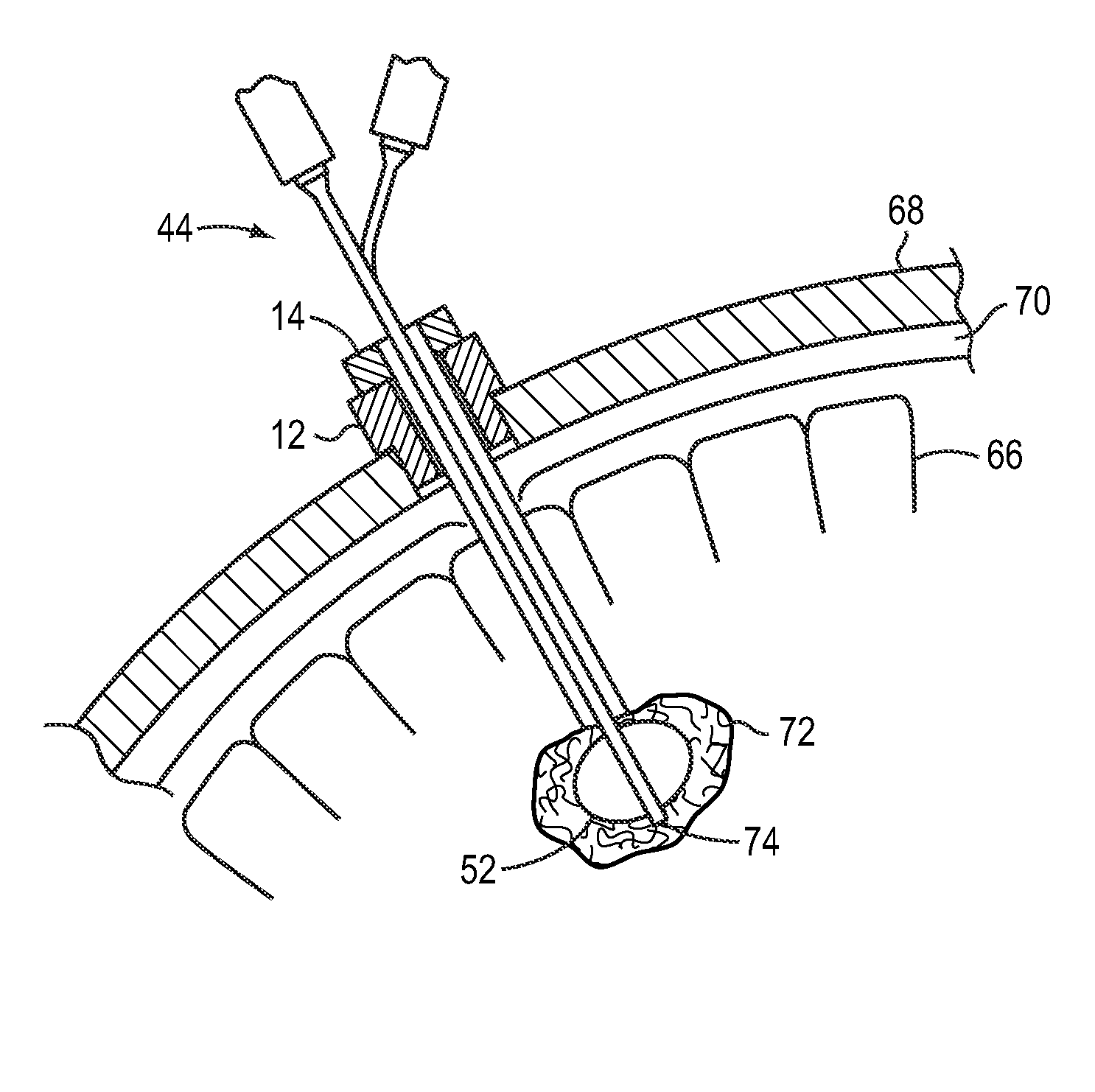 Cranial evacuation system and use thereof