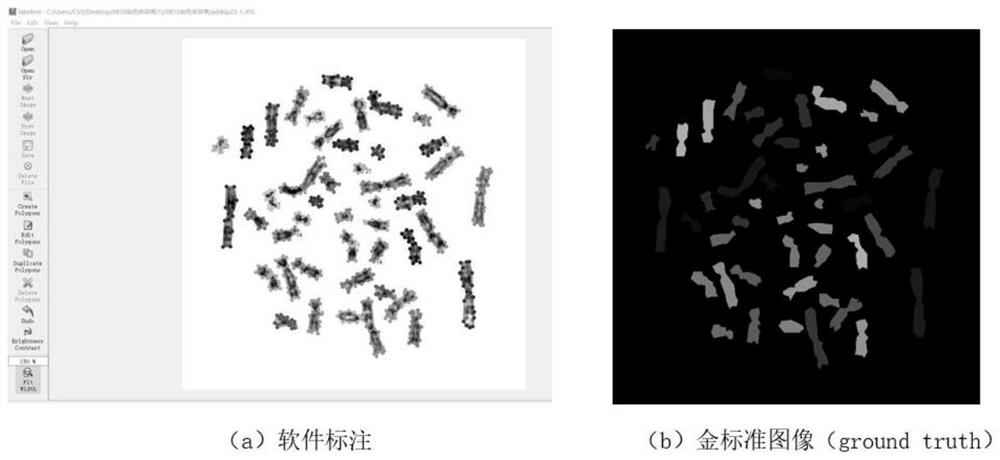 Automatic chromosome karyotype analysis and anomaly detection method